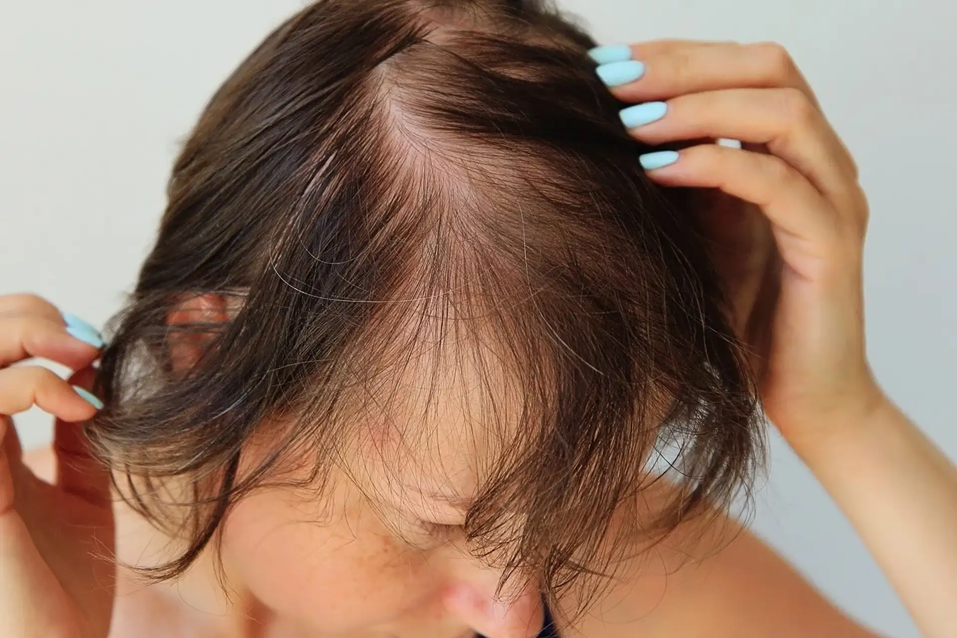 Caduta capelli donna: cause principali e rimedi