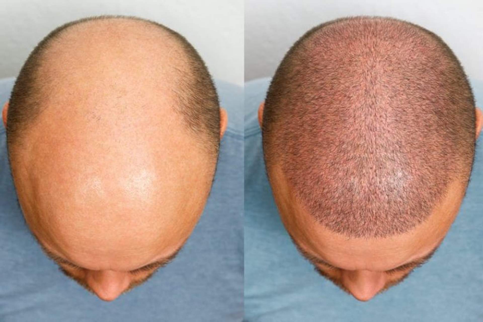 Trapianto Capelli a Tirana: Costi e Tecniche