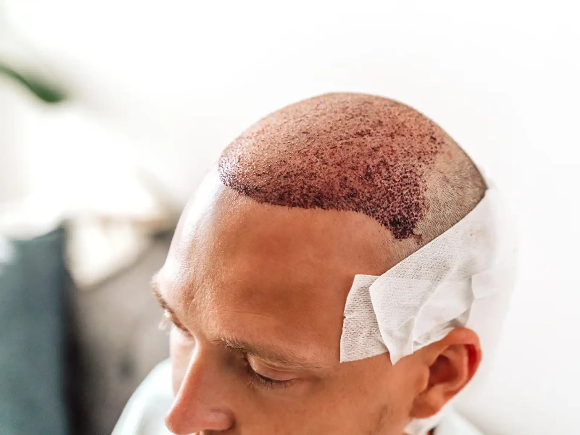 What to Do After a Hair Transplant?