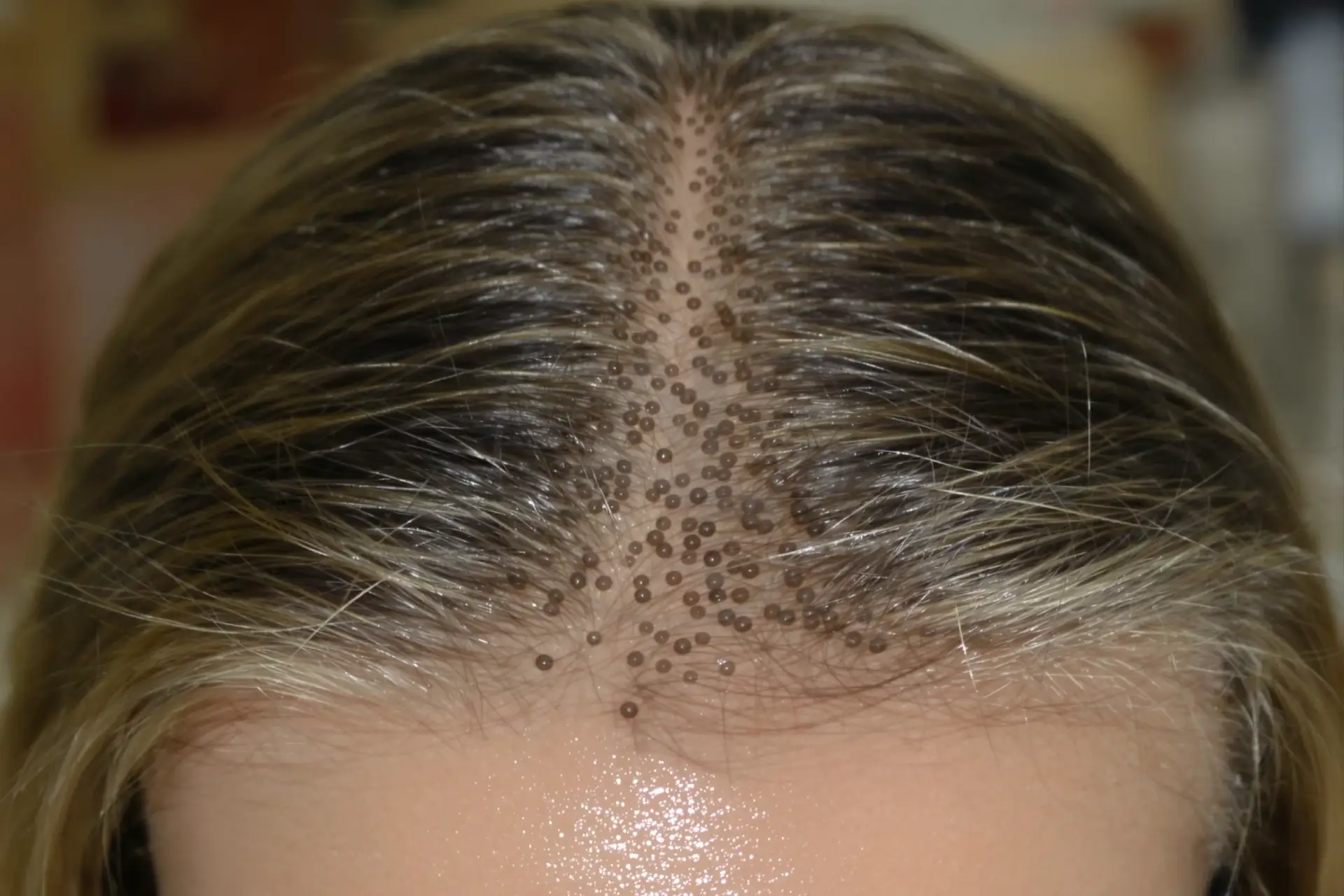 Primo piano del cuoio capelluto di una donna con i bulbi piliferi visibili