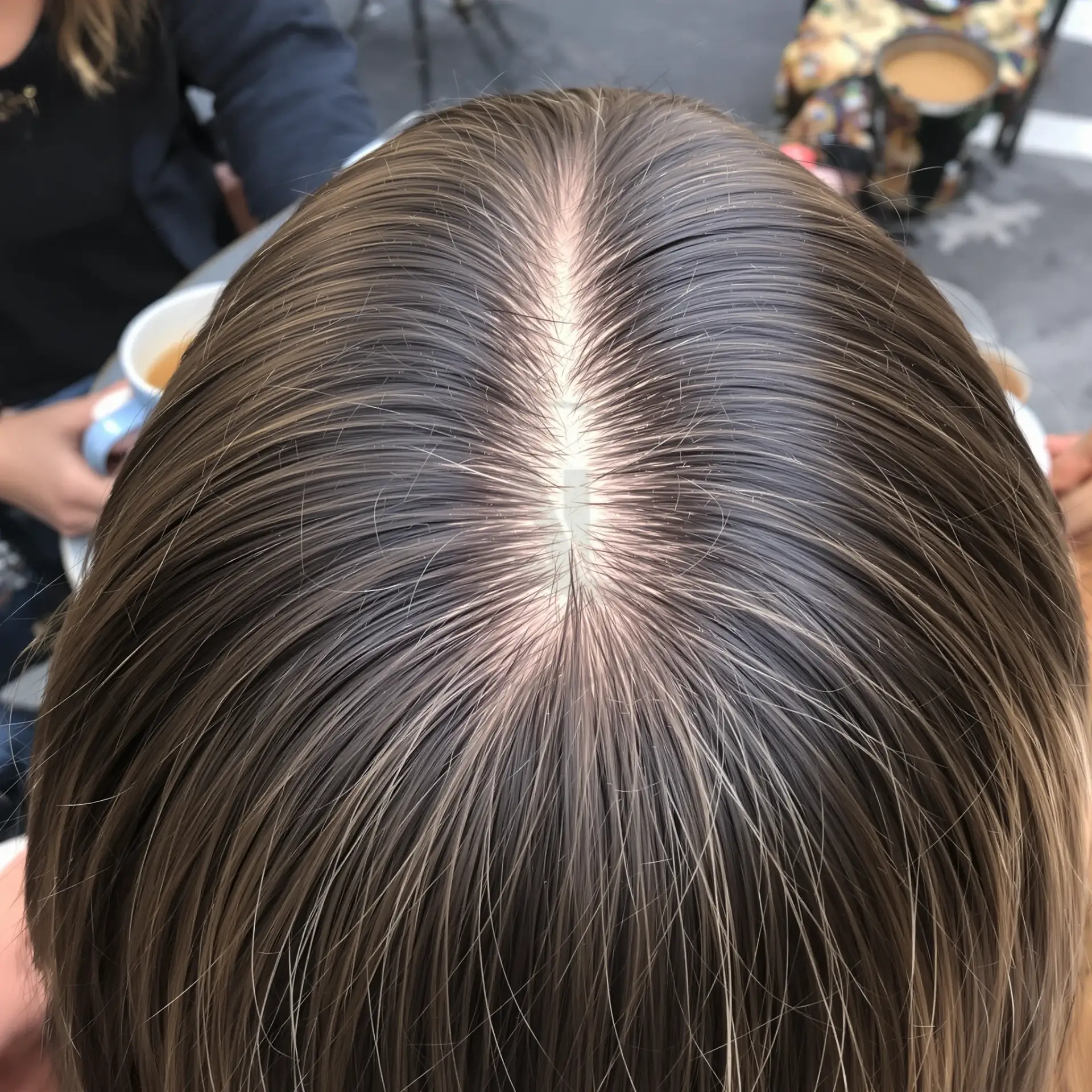 Dettaglio della riga dei capelli che si allarga per alopecia androgenetica.