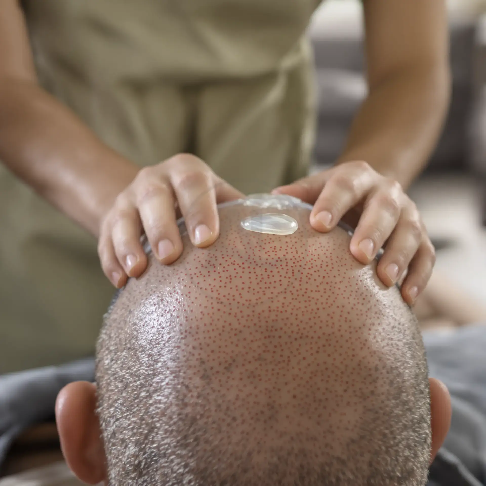 Applicazione di gel post-operatorio sul cuoio capelluto di un uomo dopo trapianto.