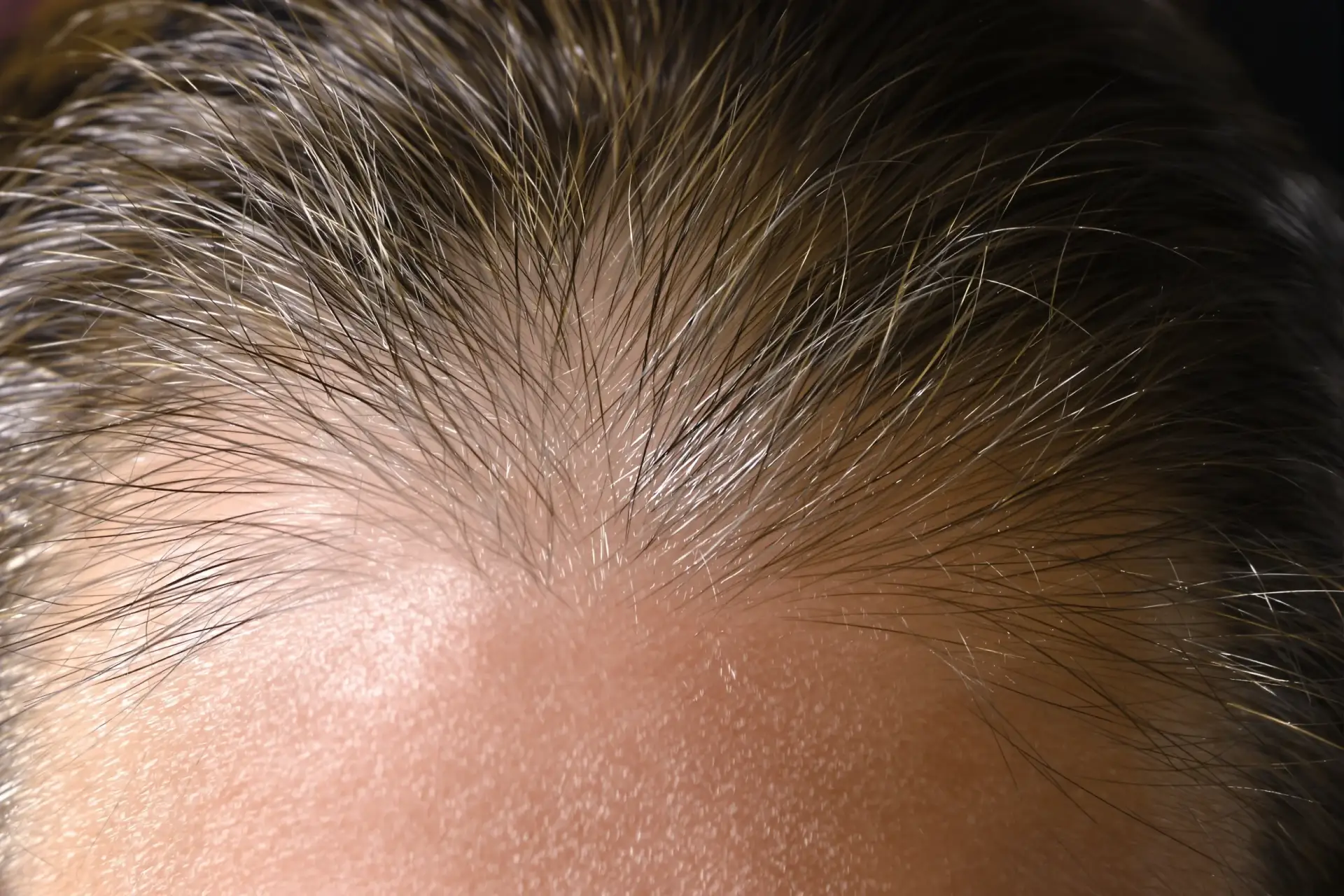 Trapianto di Capelli in Albania: Costi e Risultati 2026