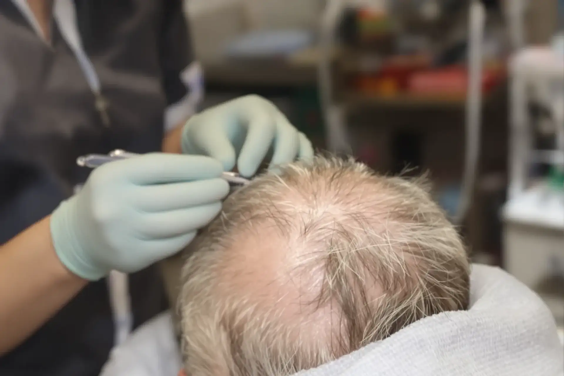 5000-grafts-hair-transplant-turkey
