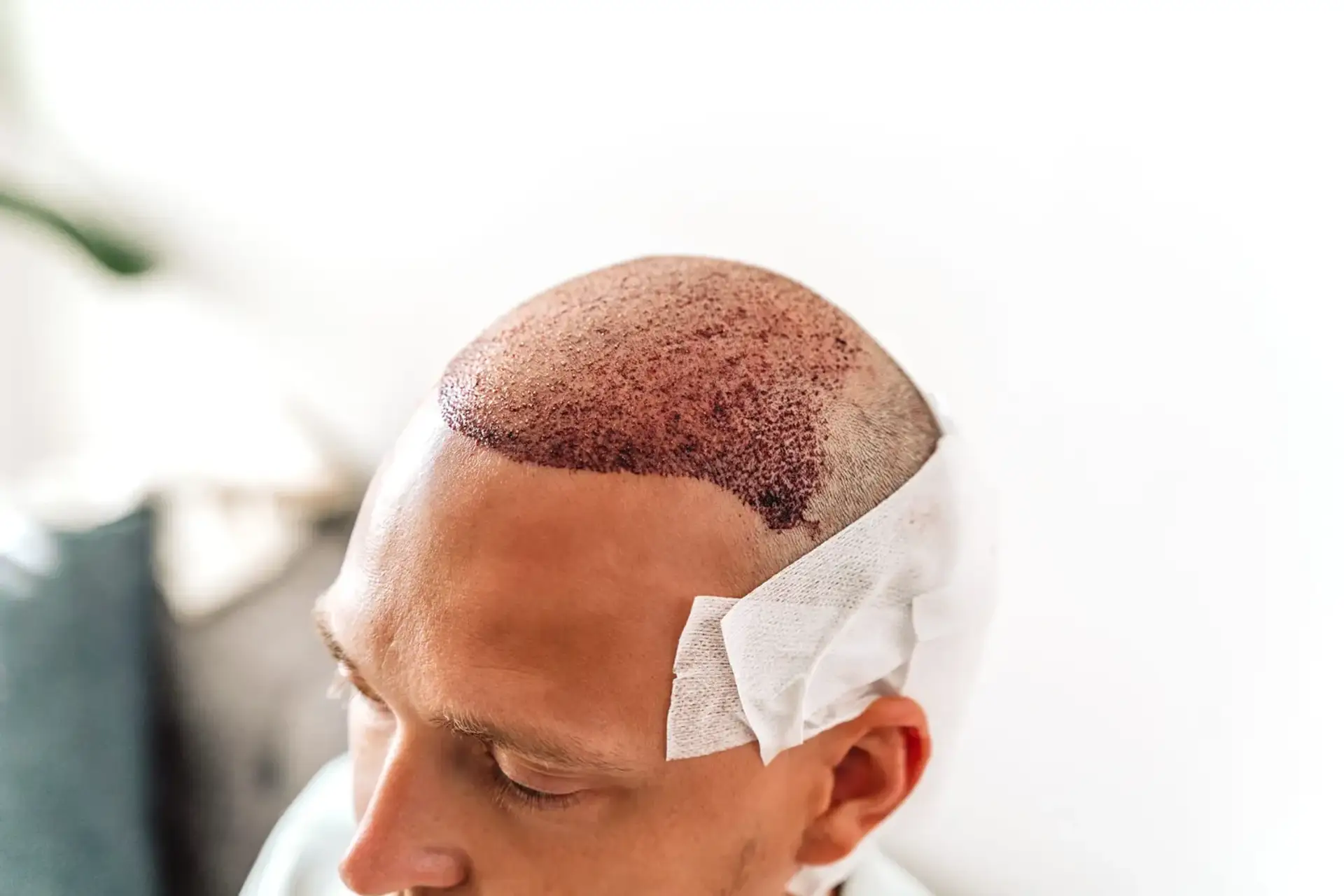 Albania or Turkey for a hair transplant.