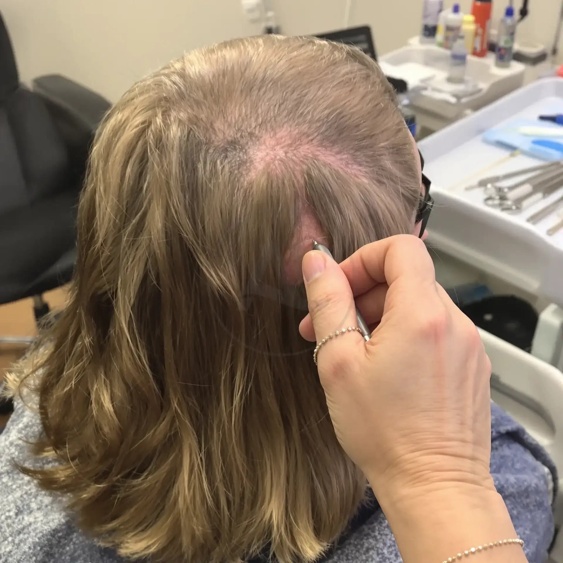 Clinician pointing with a pen at a womans thinning crown during a scalp assessment