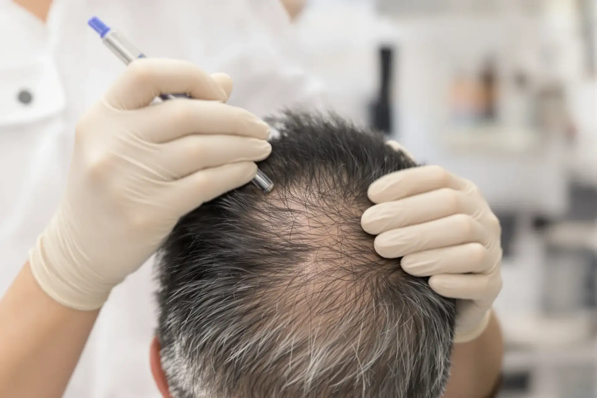 FUE Hair Transplant Explained: The Basics