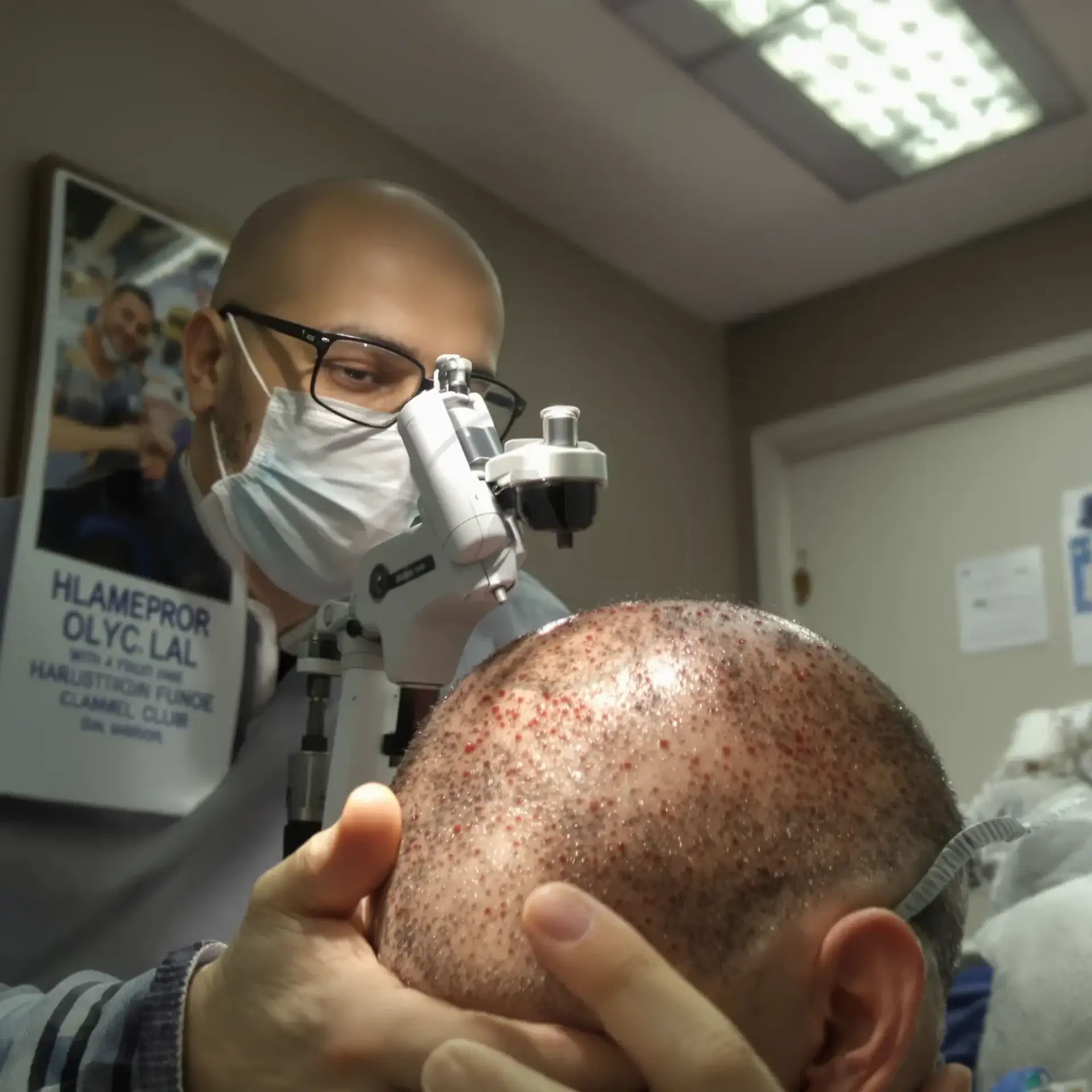 Surgeon using magnifying loupes to examine a shaved scalp with red graft points during a hair transplant