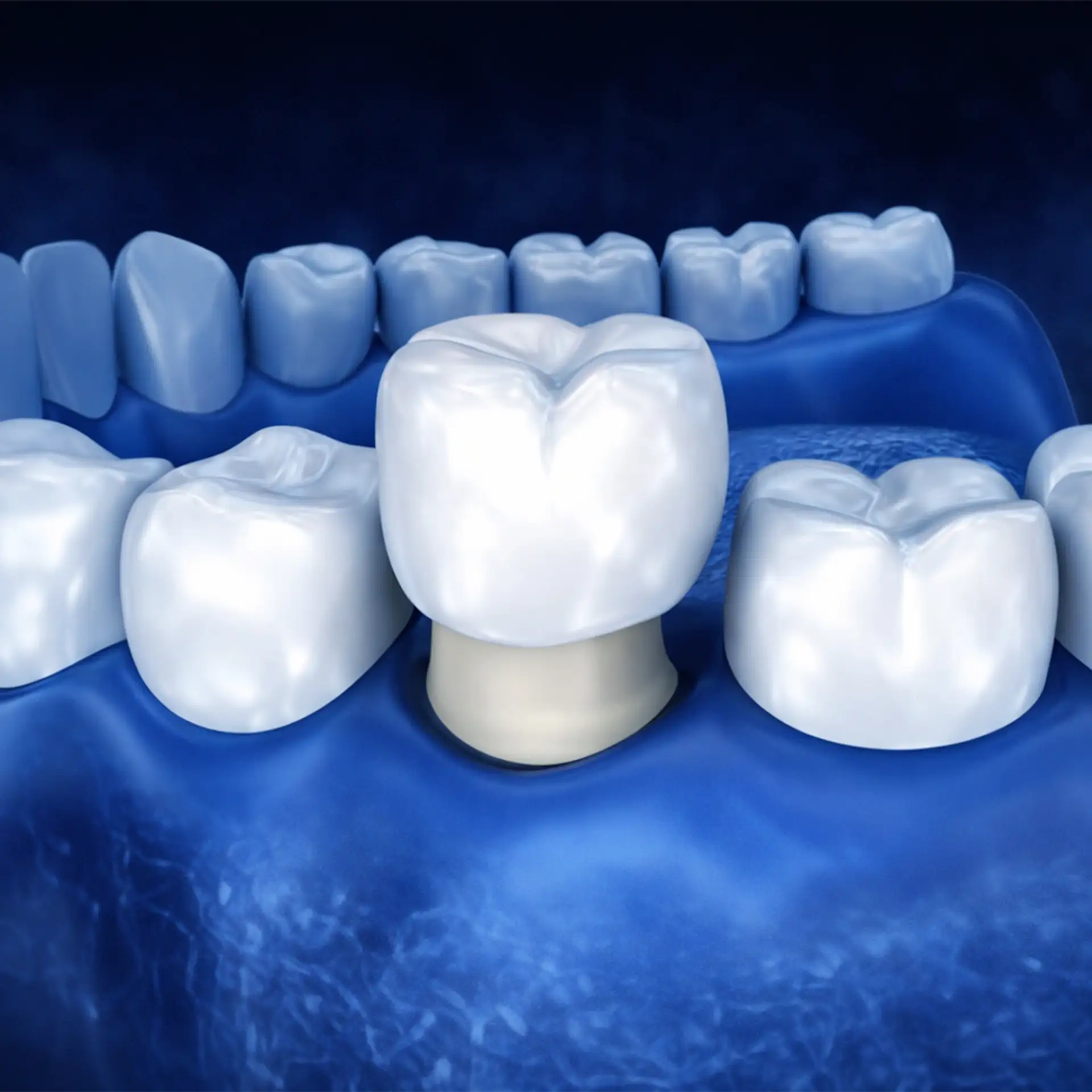 How Long Do Zirconium Crowns Last