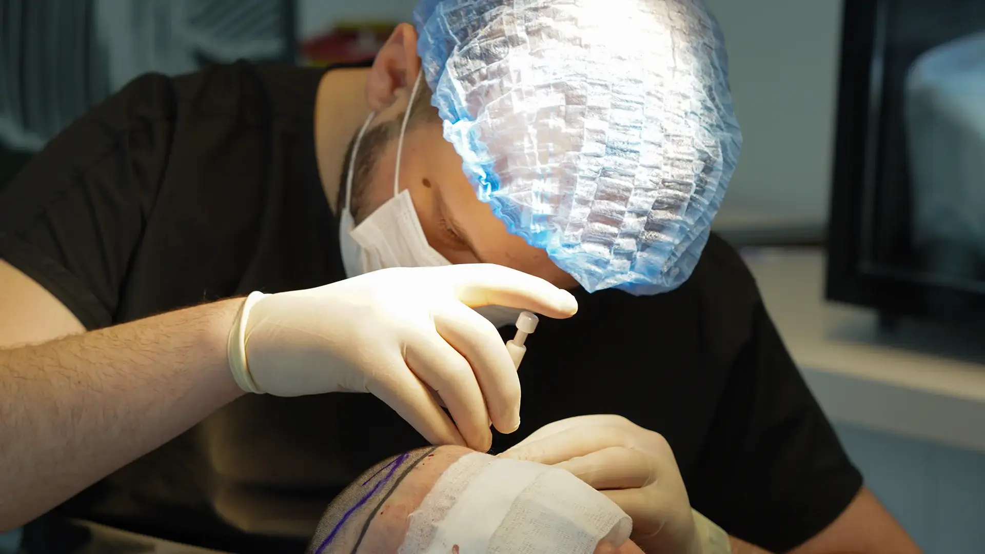 understanding-dhi-hair-transplant Method