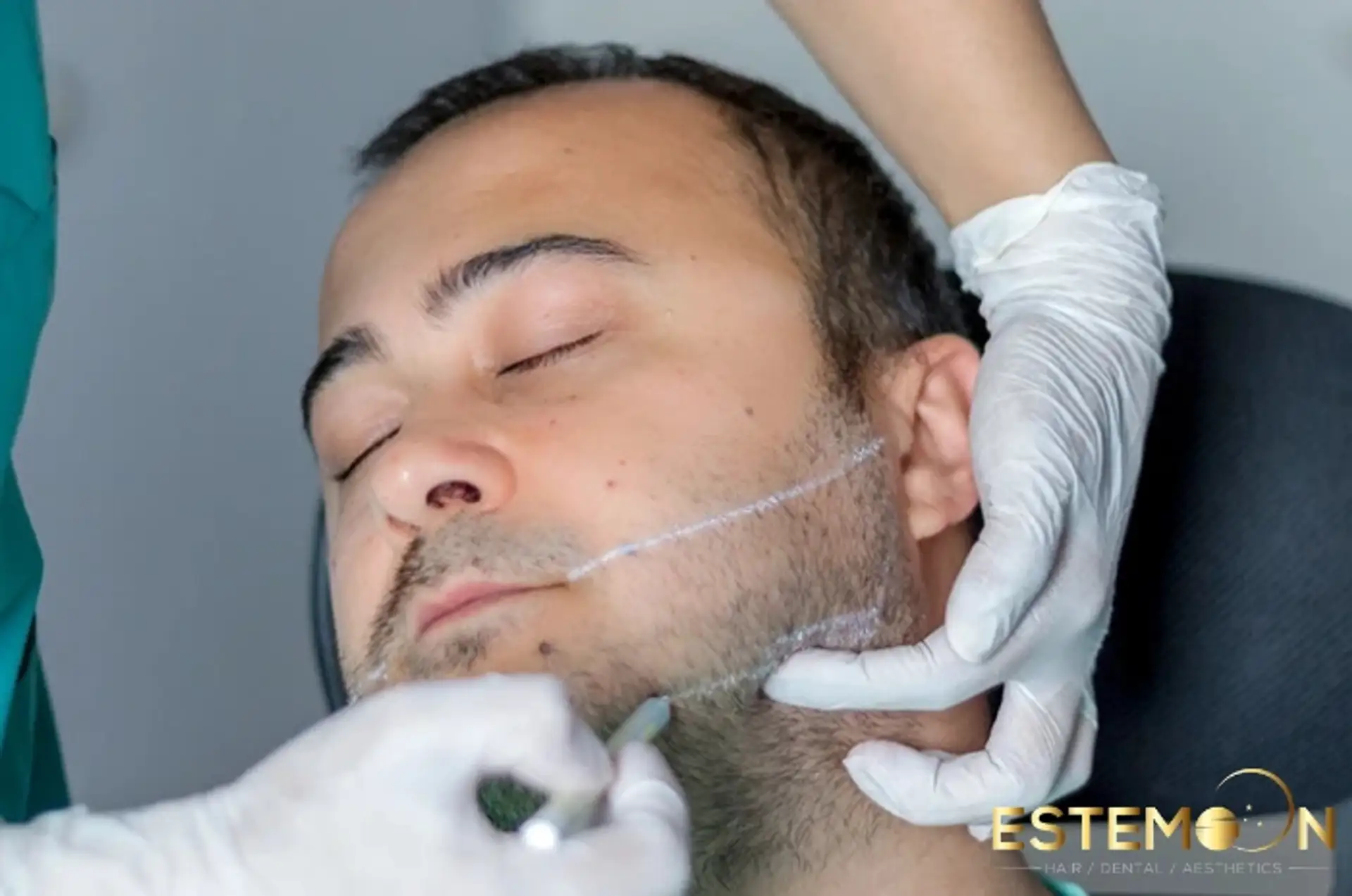 beard transplant in turkey