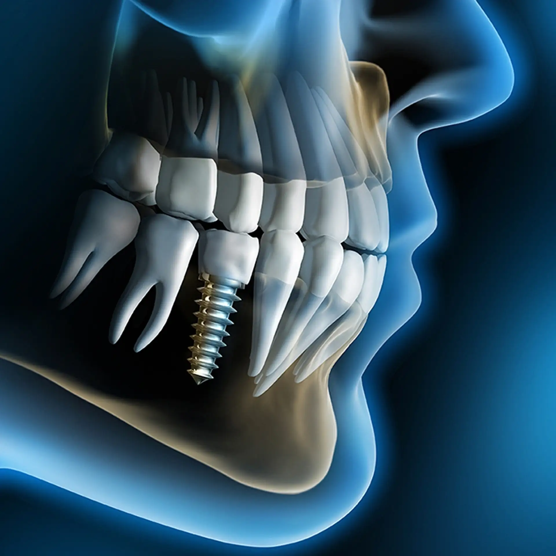 What Is Dental Implant