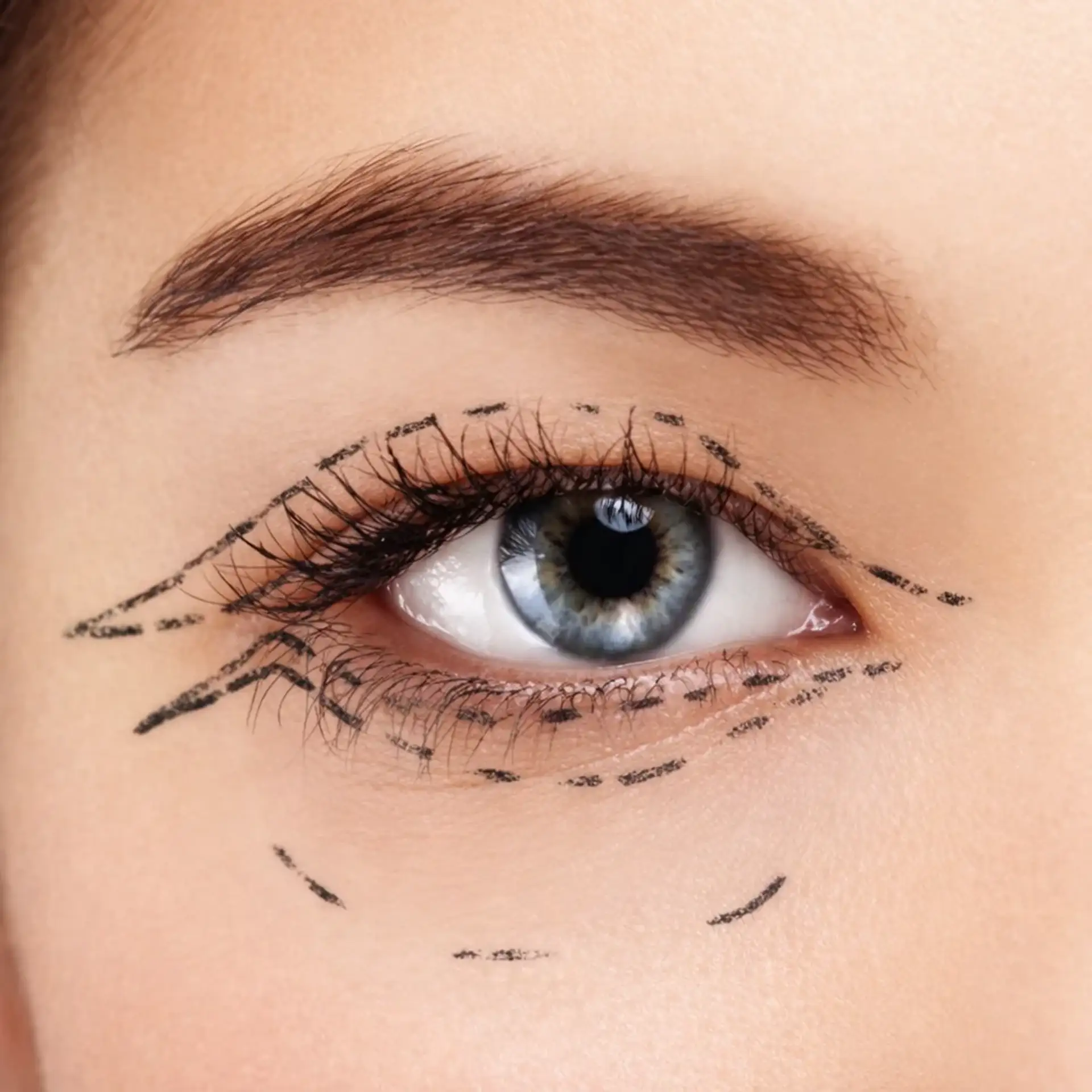 What Is Upper Eyelid Surgery?