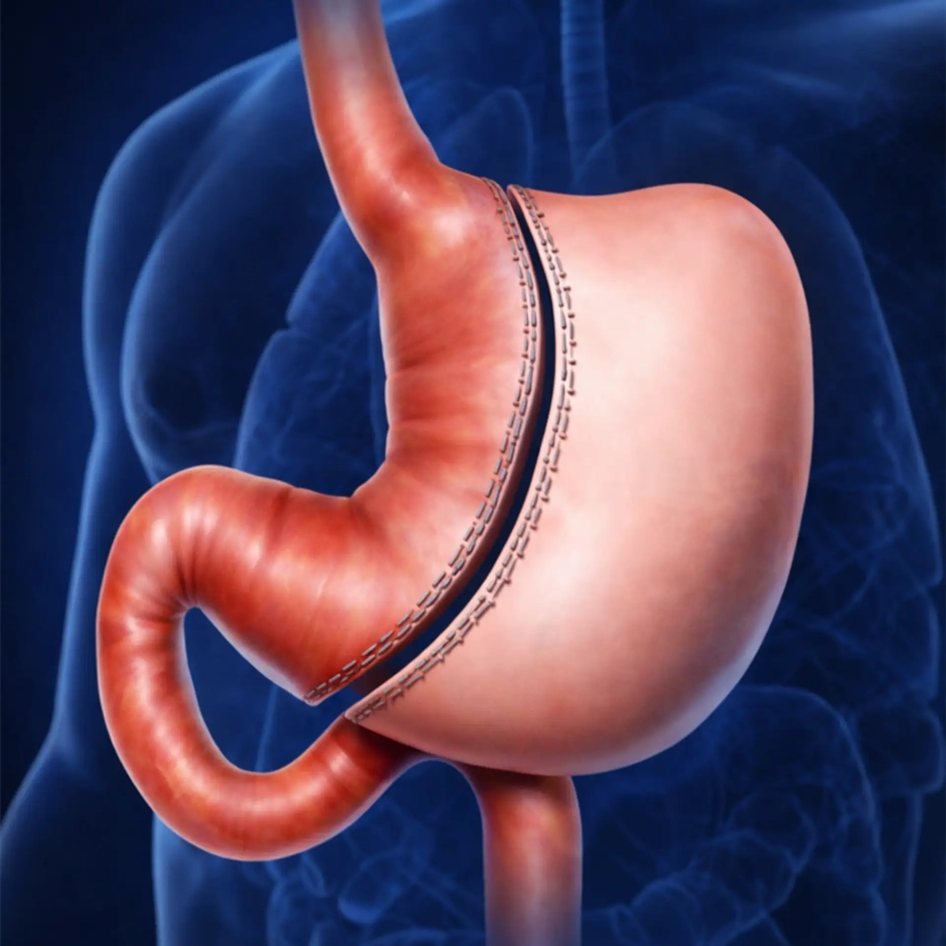 What Is Sleeve Gastrosectomy
