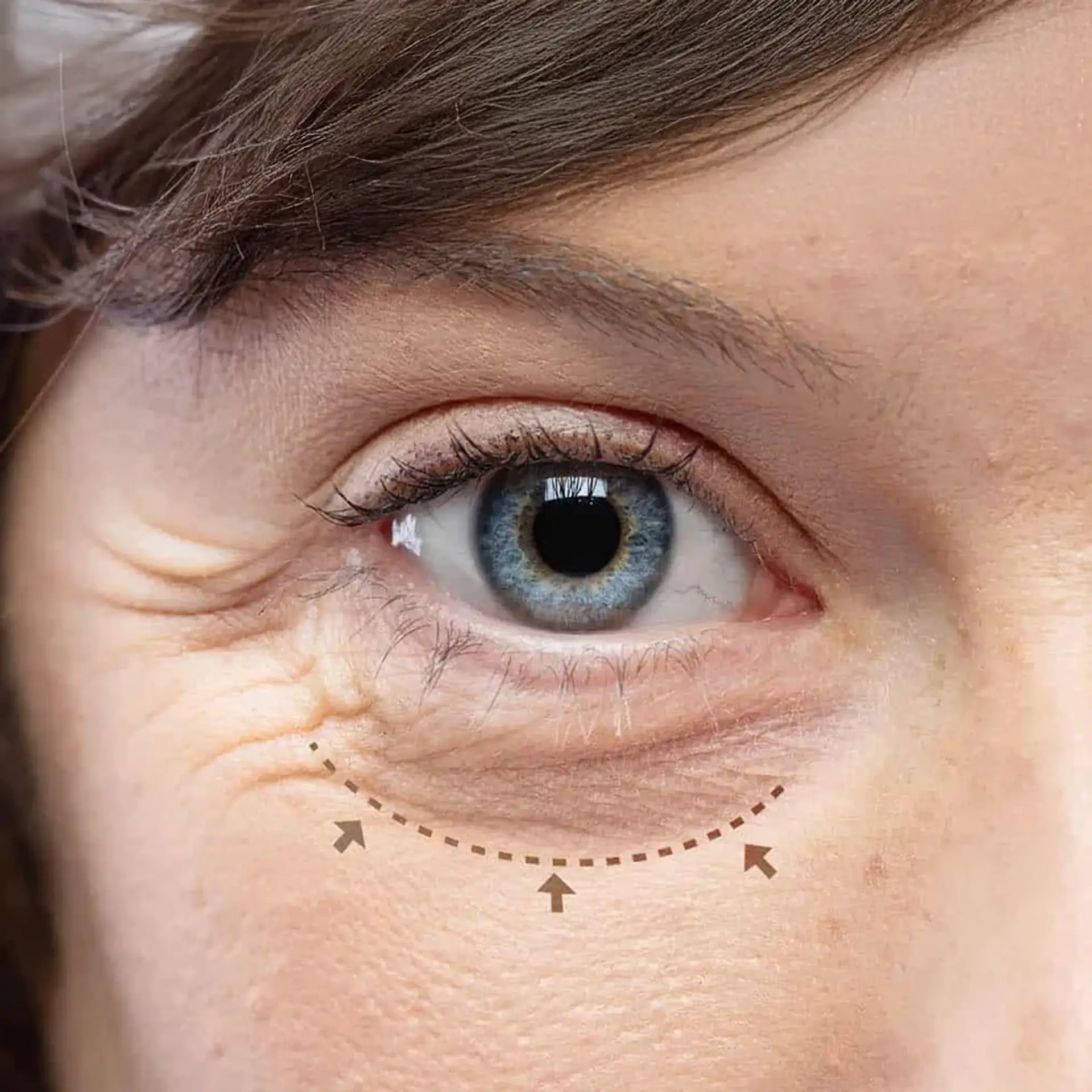 Before the Eyelid surgery
