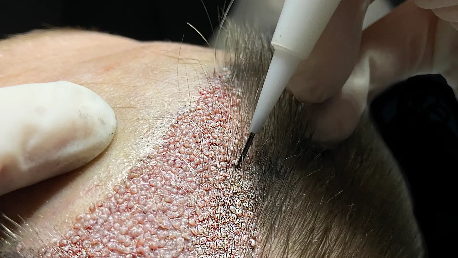 dhi-hair-transplant