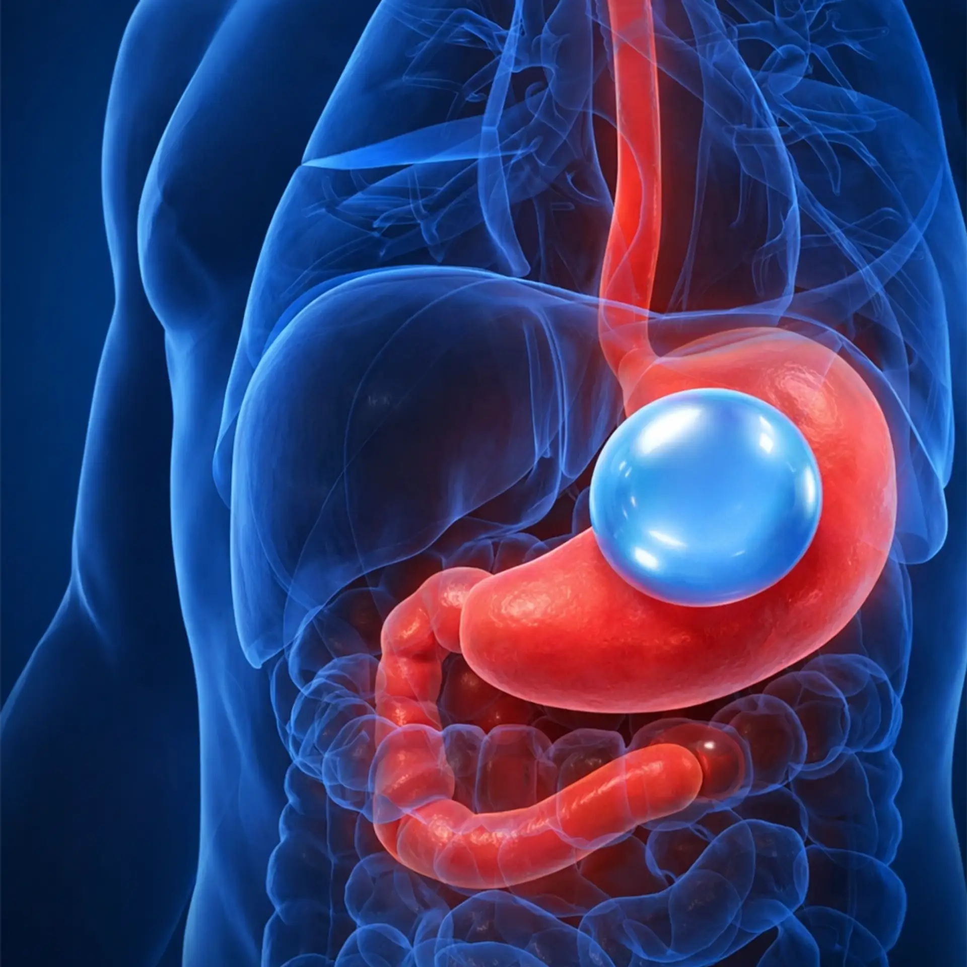 Gastric Balloon in Turkey