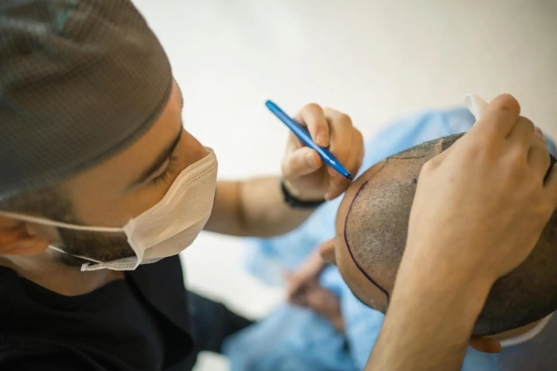 Quando aspettarsi i risultati del trapianto di capelli con