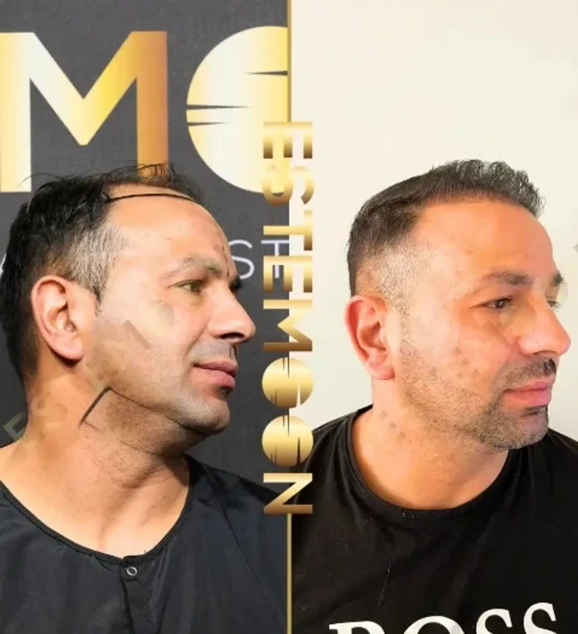 Massaggio del cuoio capelluto dopo il trapianto di capelli