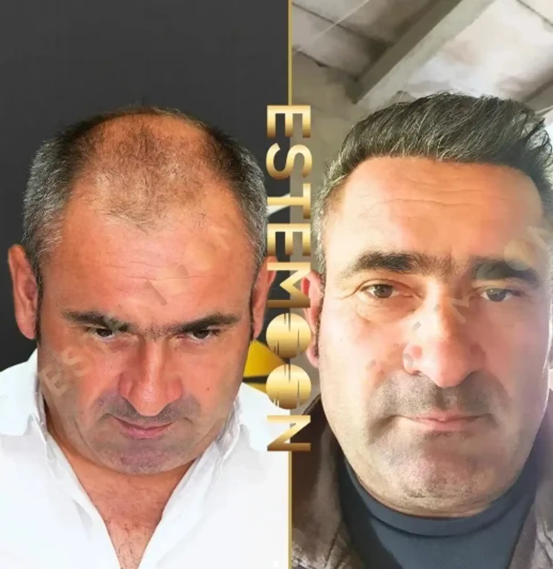 DHI Transplant in Albania: Achieve Natural Hair Restoration