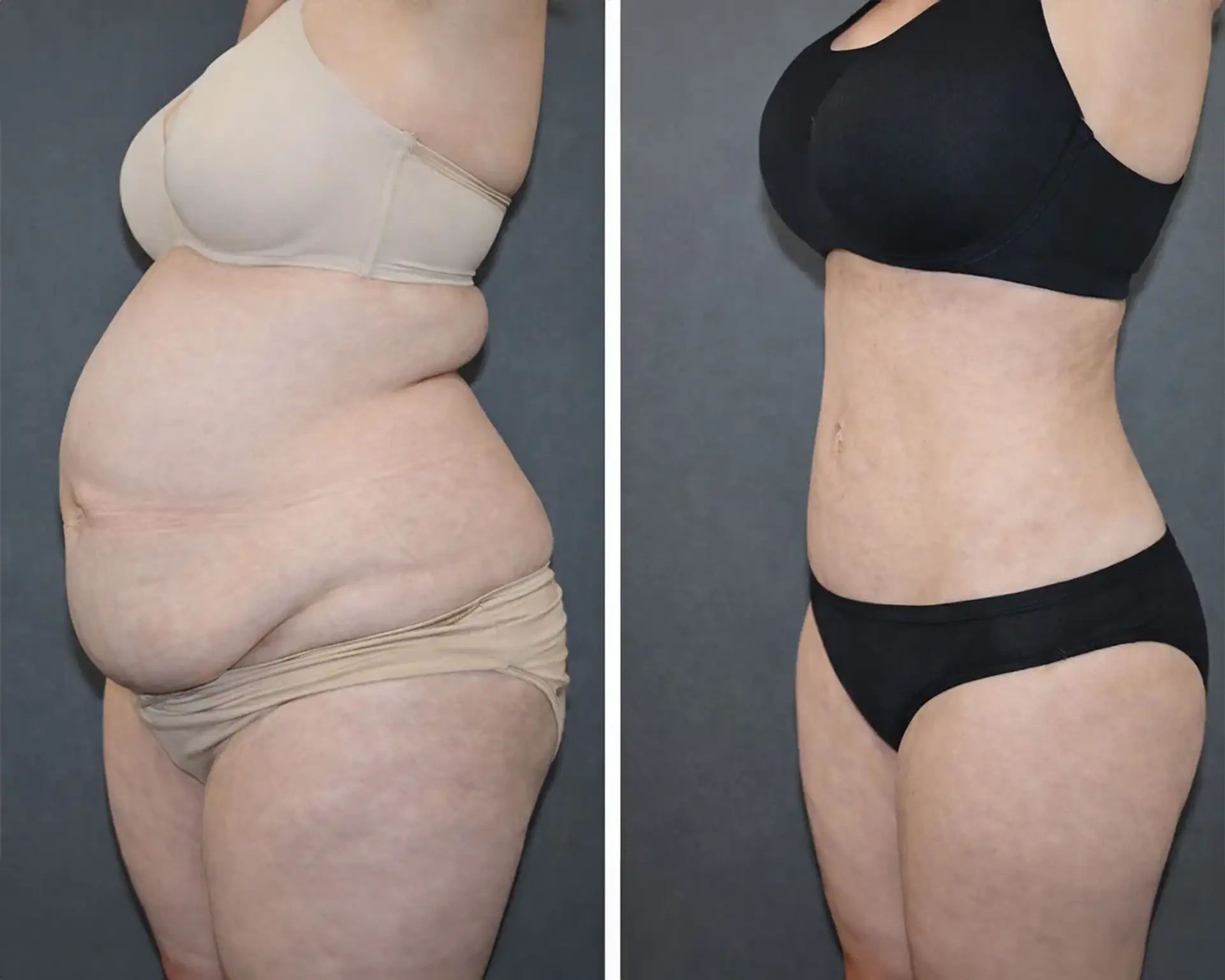 mega-liposukcja