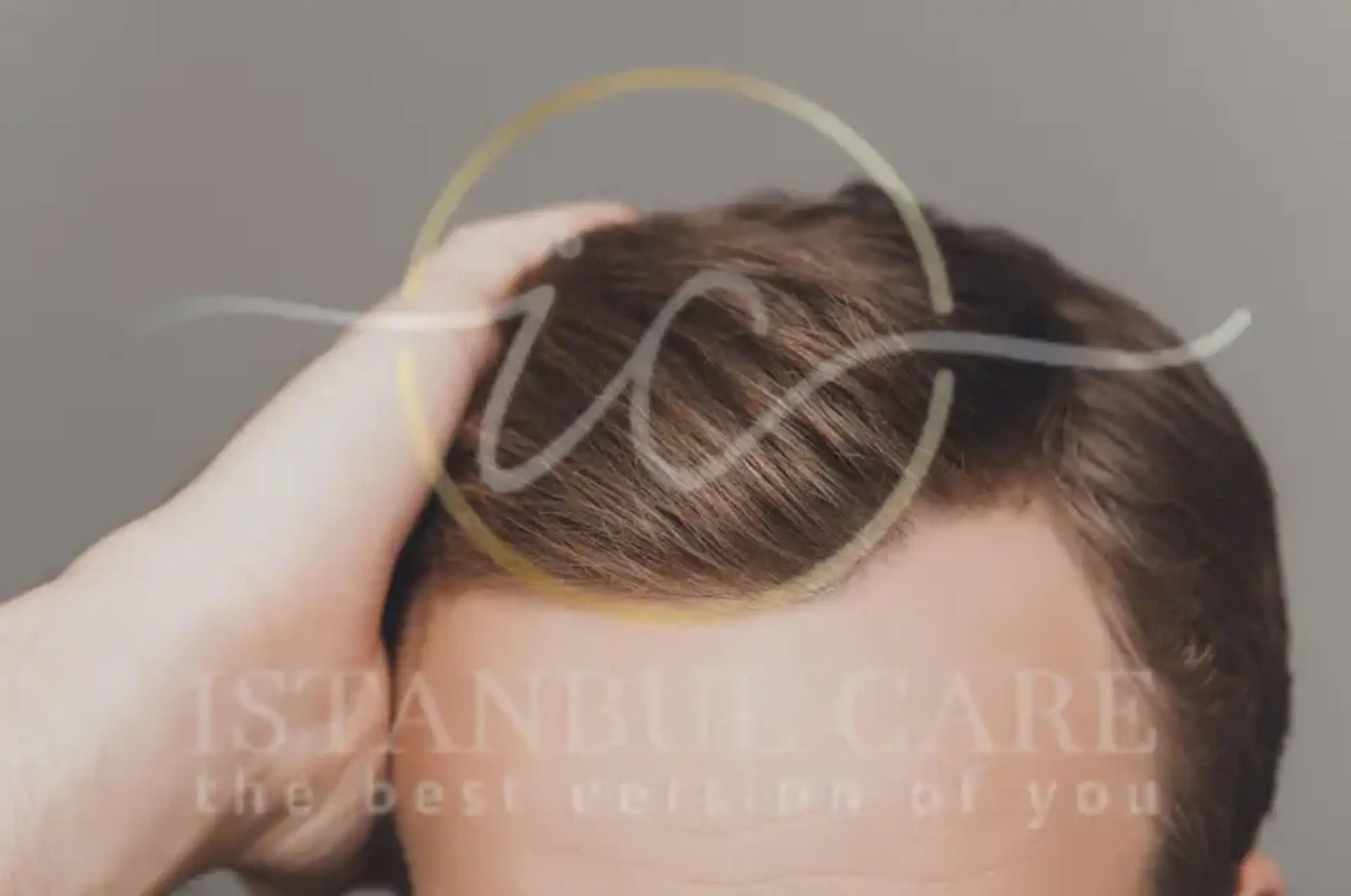 Adrenal Tiredness How Stress Hormones Affect Hair