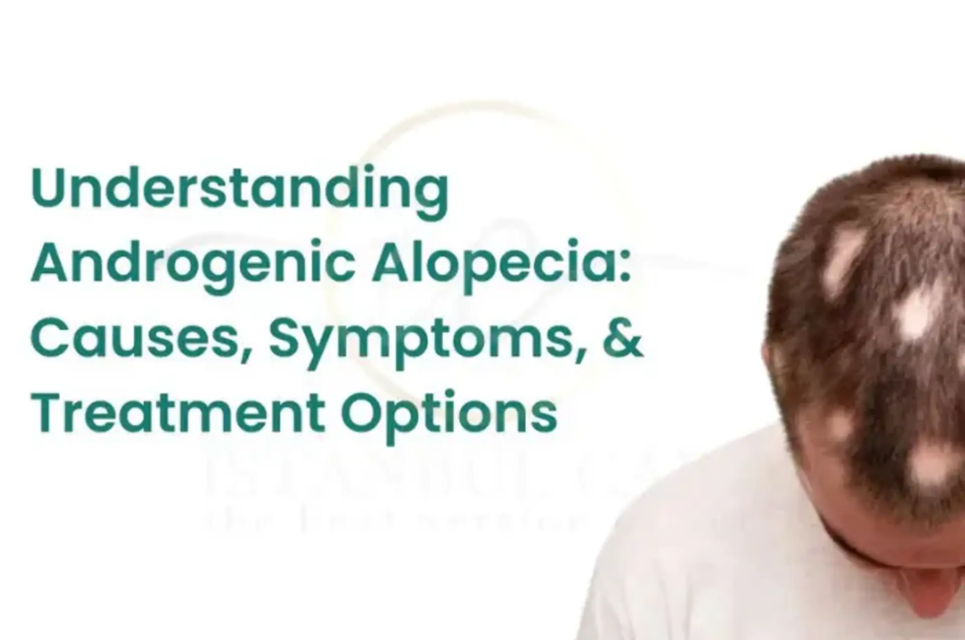 Alopecia androgenowa