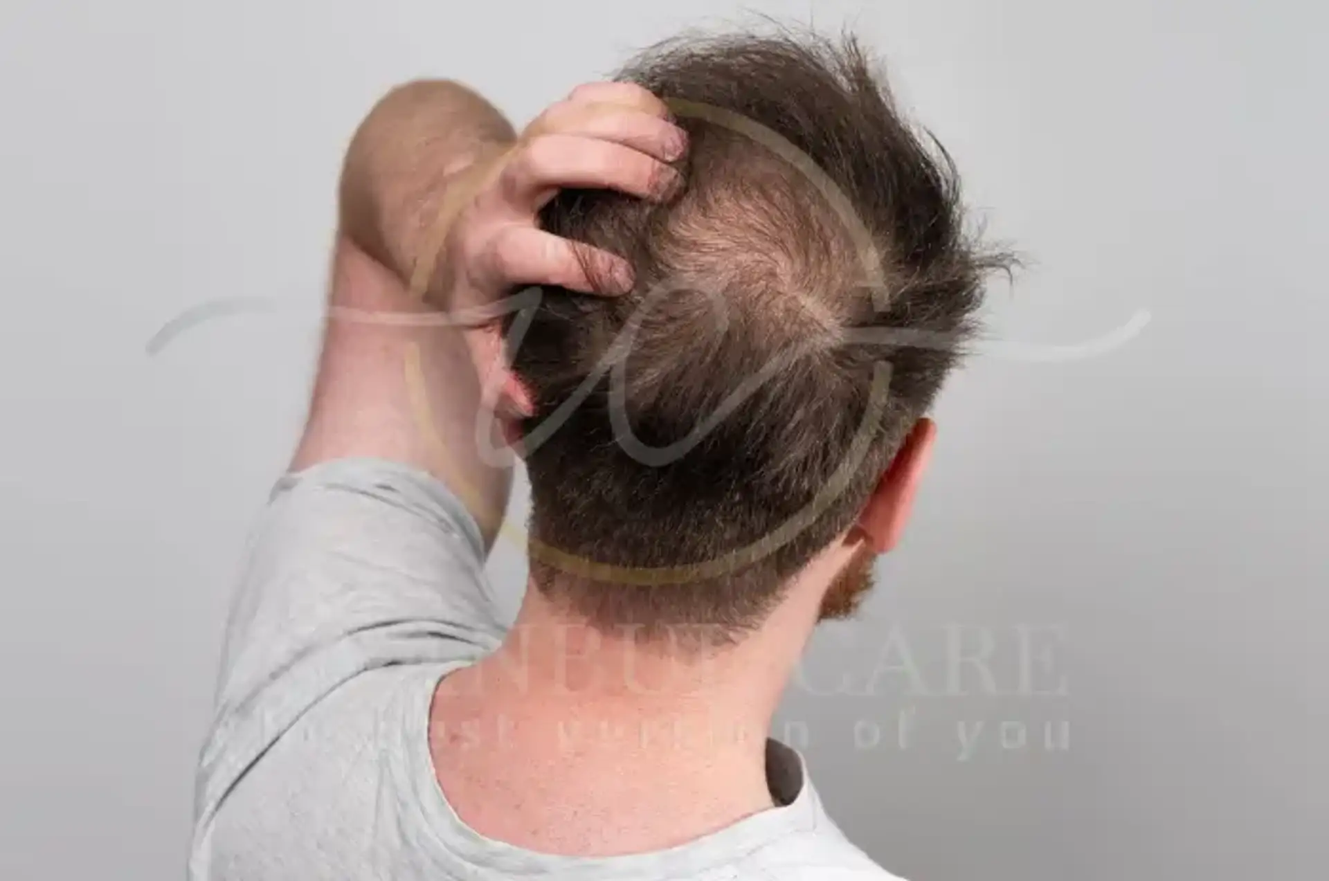 Crown Balding