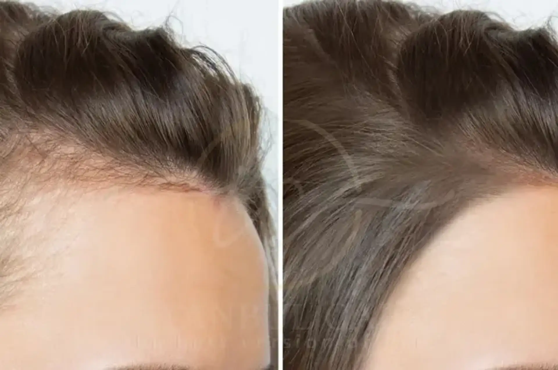 Hair Loss in Women