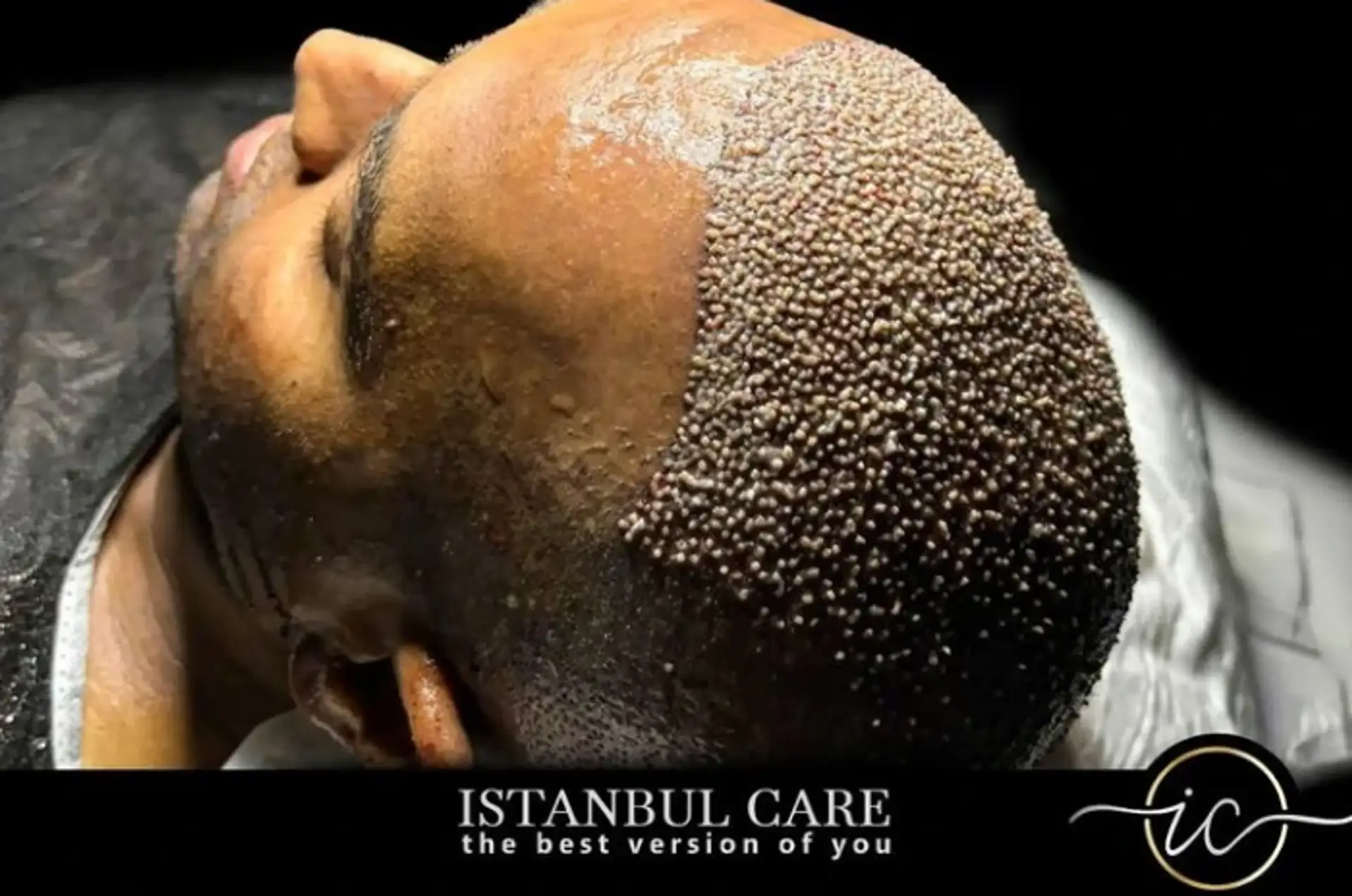Hair Restoration