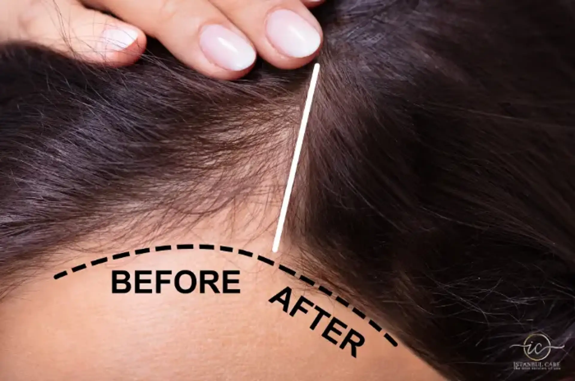 Understanding How Vitamin Deficiency Causes Hair Loss