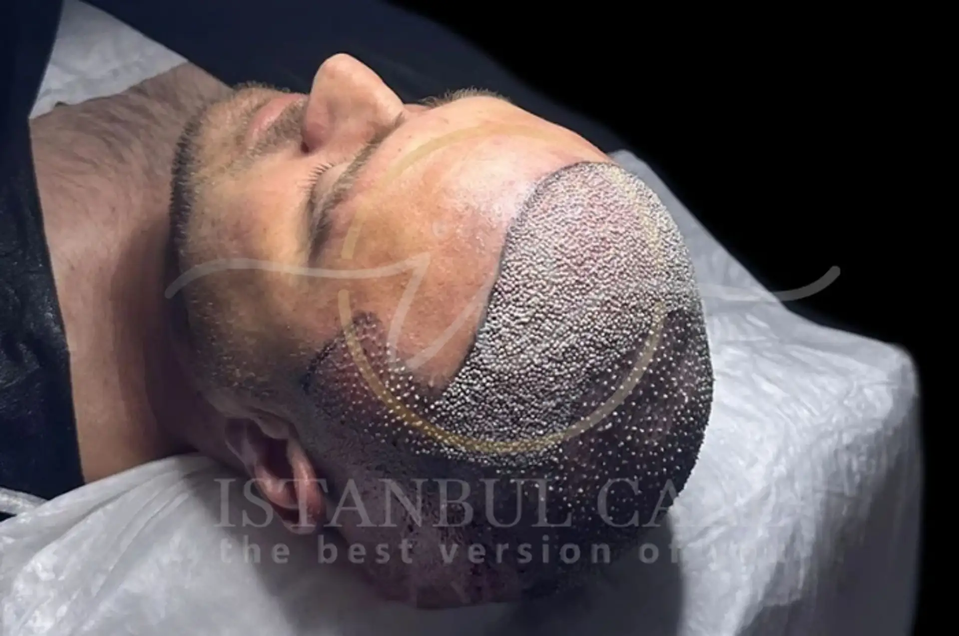 Haartransplantation vs. PRP: Die besten Lösungen gegen