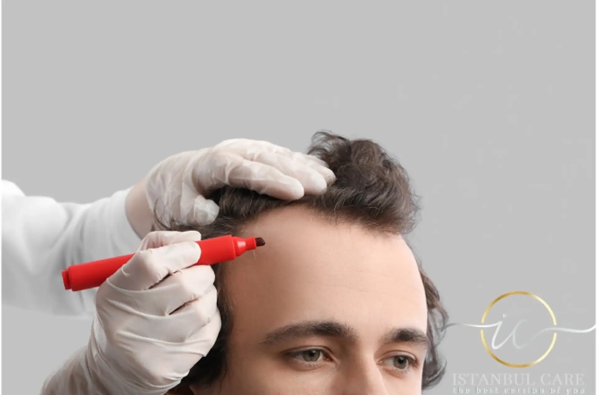 FUE Transplant in Albania