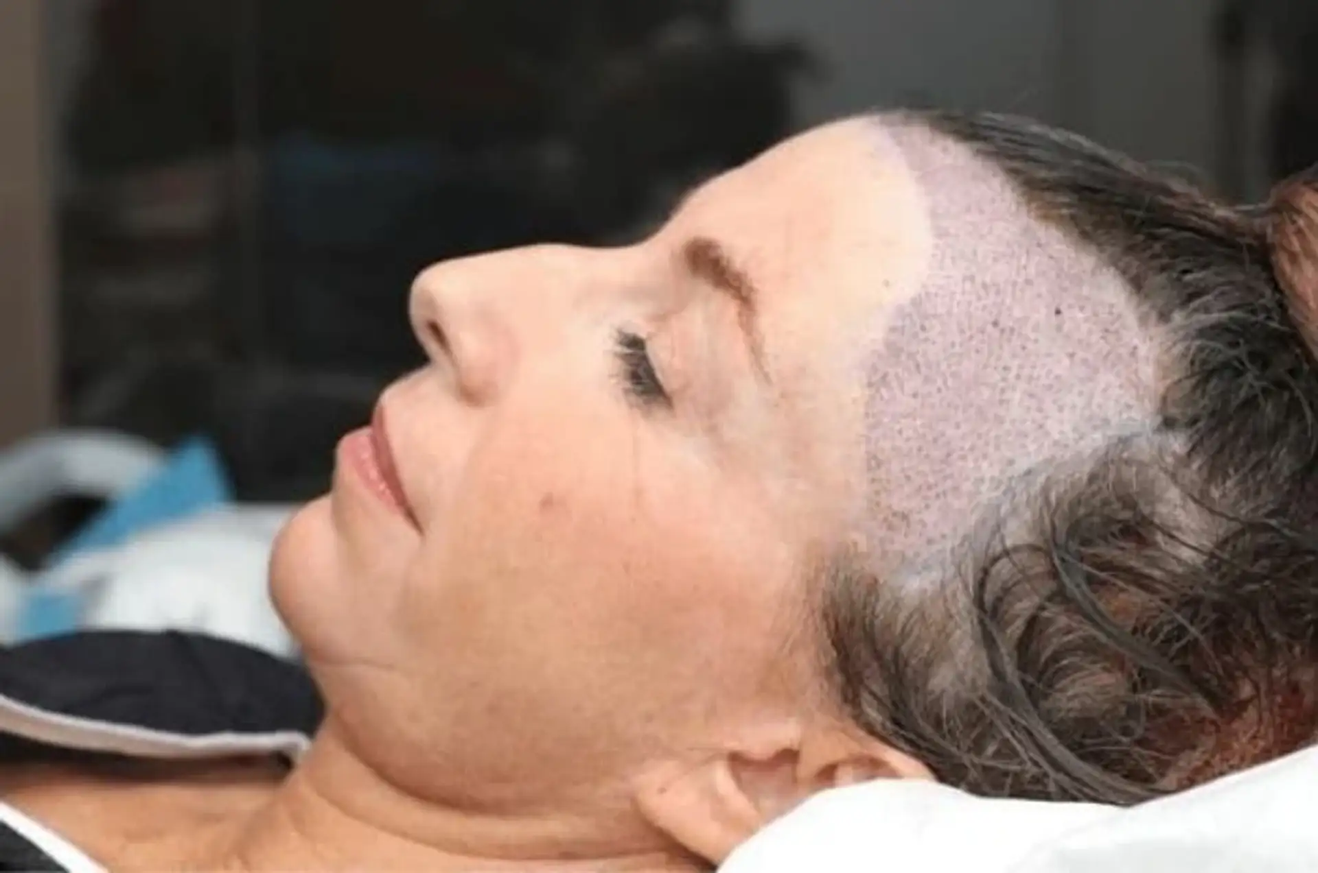 Women-Hair-Transplant