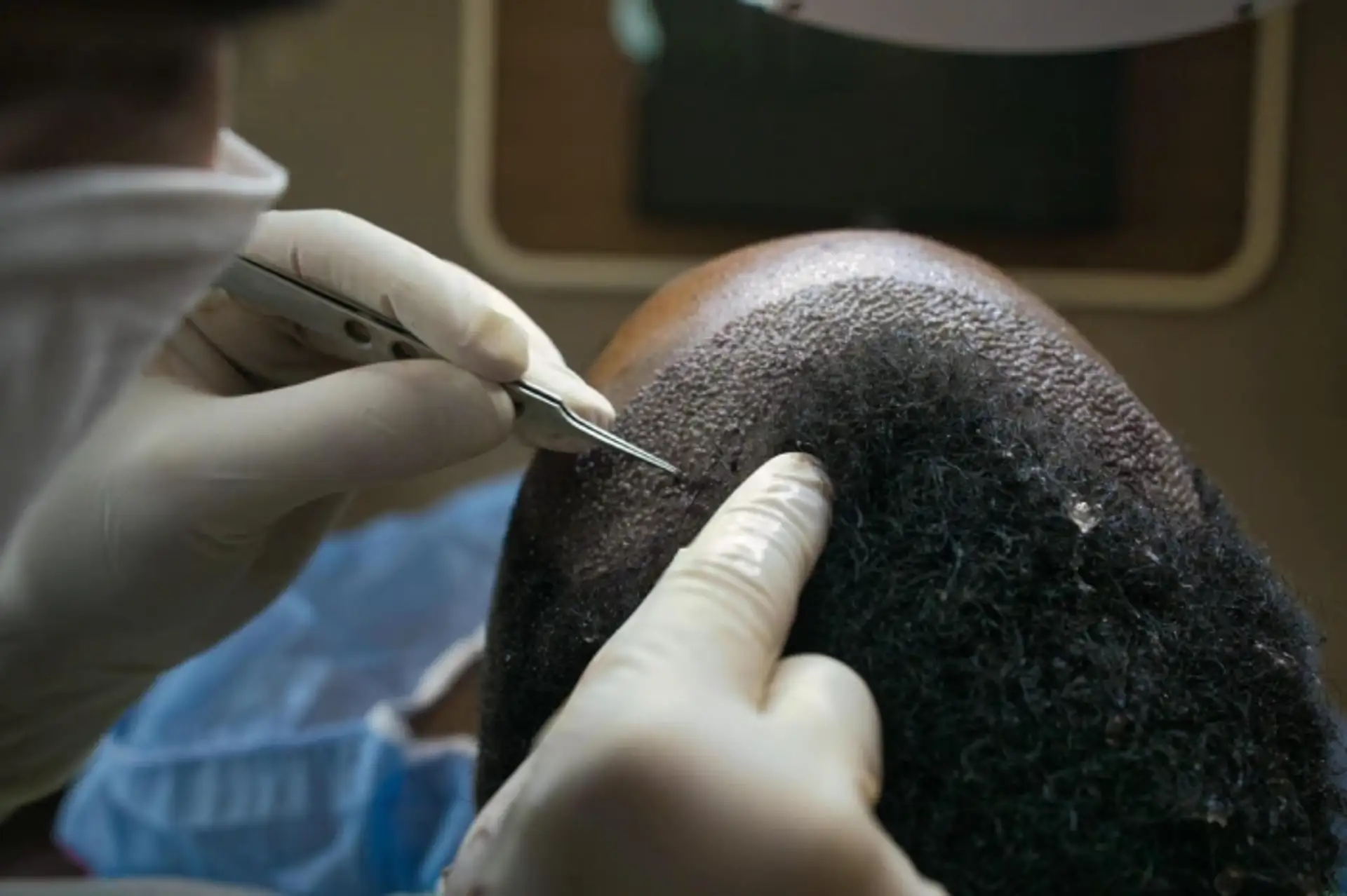 afro hair transplant black men