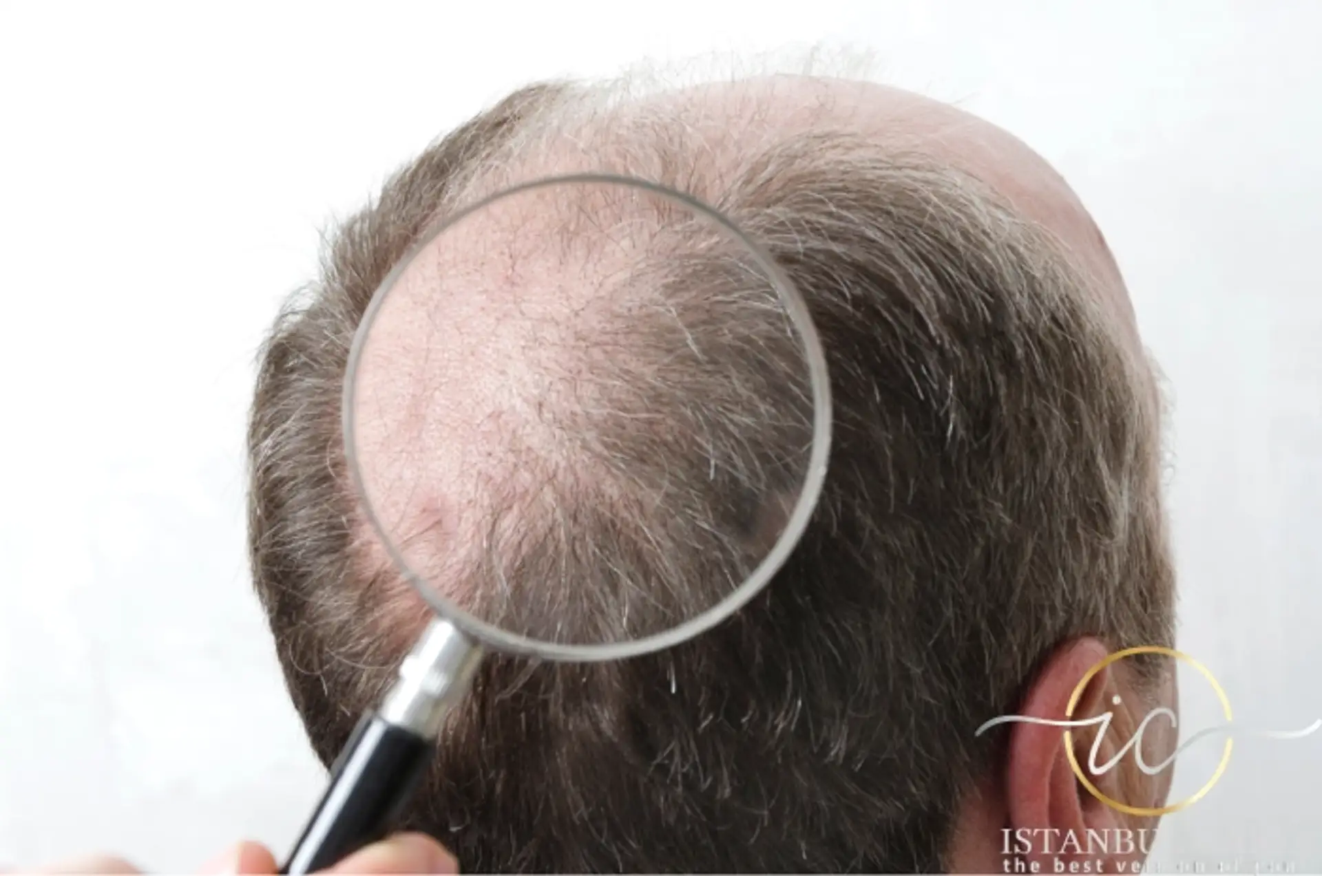 auses of hair transplant failure