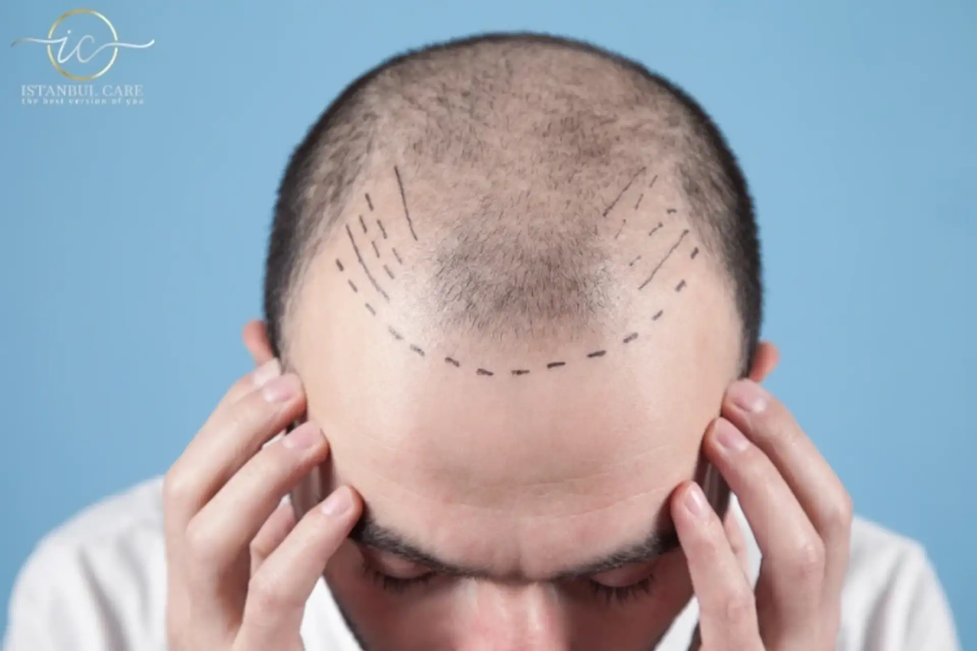 Hair Transplant Success Rate: What You Need to Know