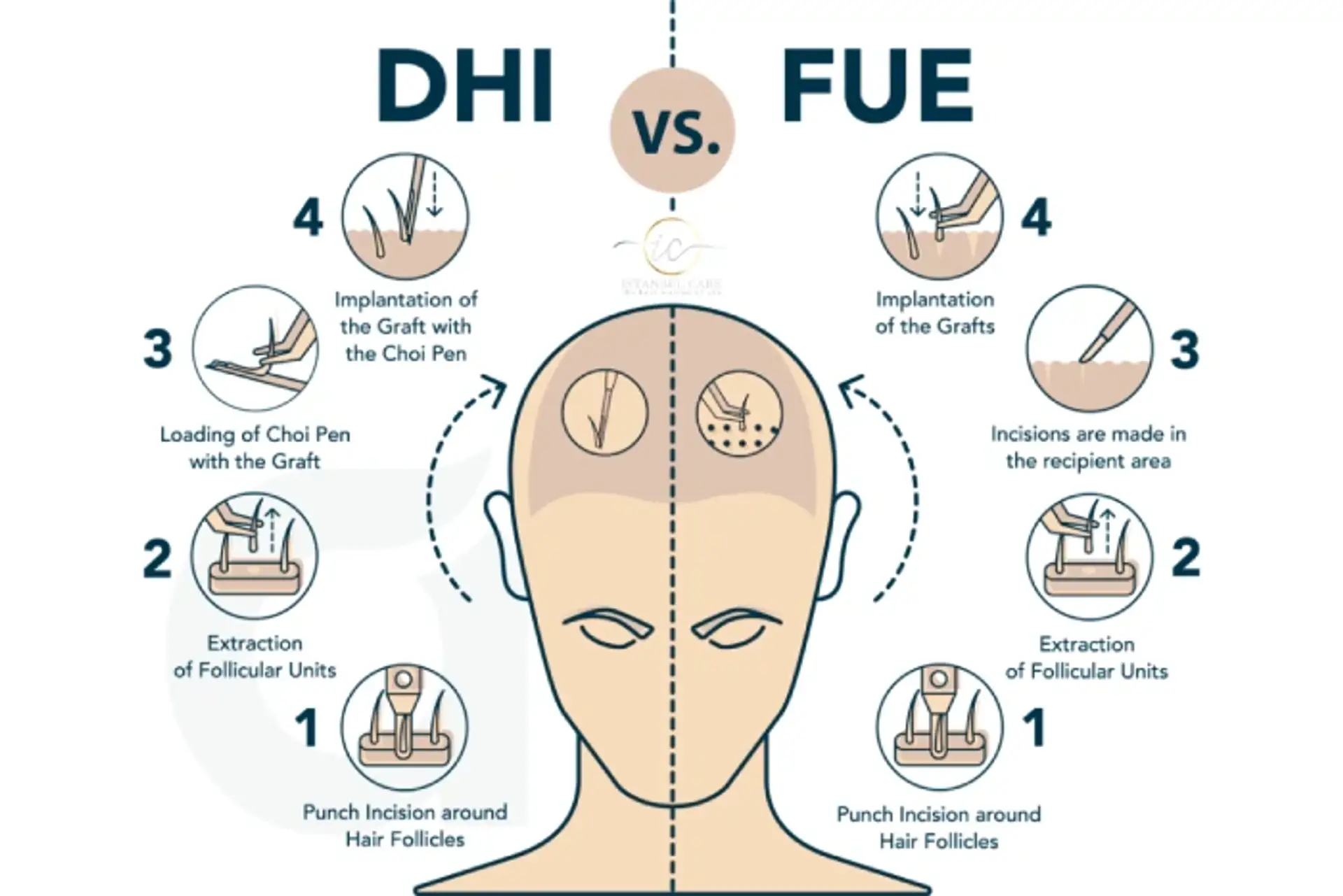 dhi vs fue turkey hair transplant