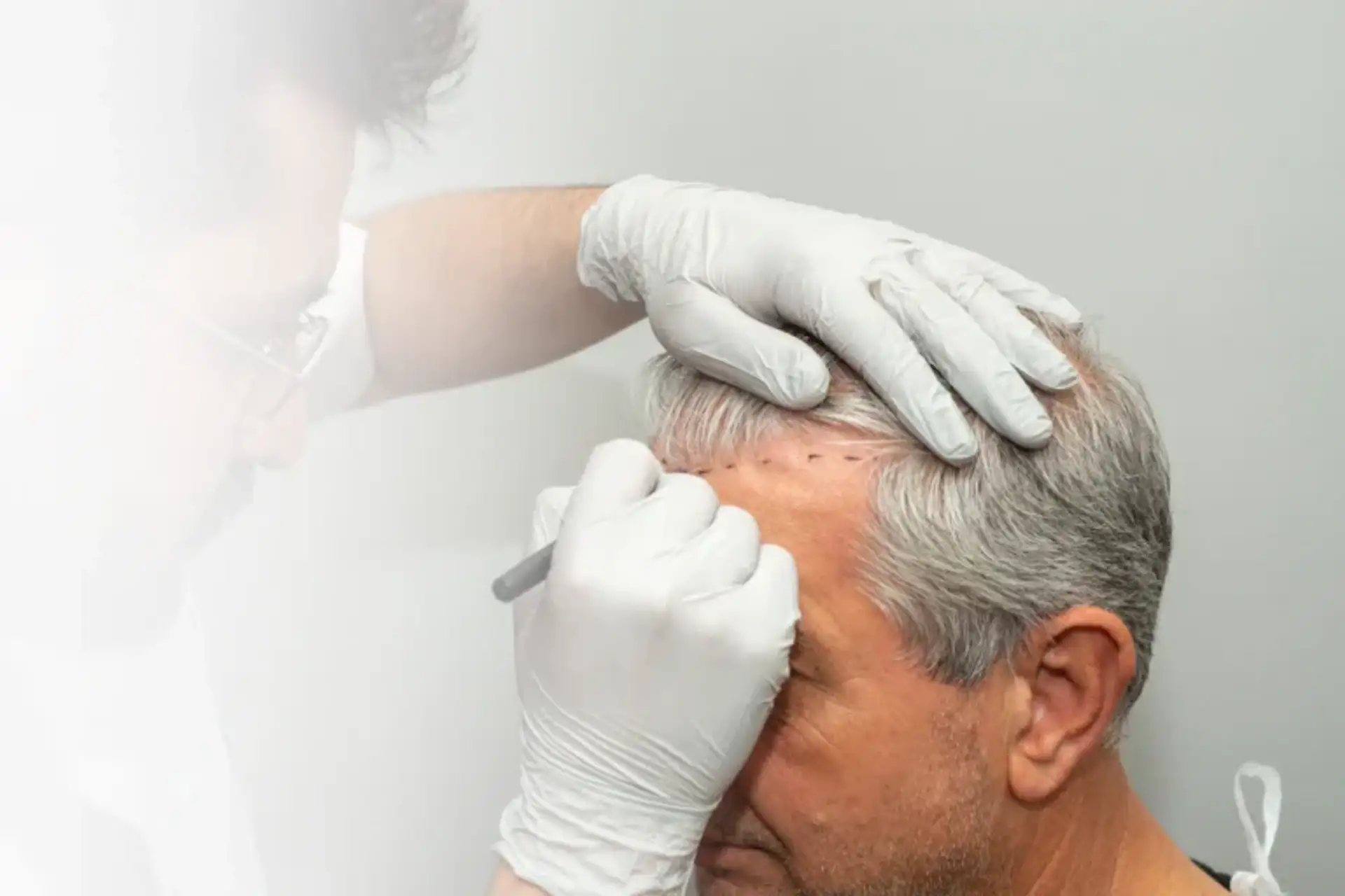 hair-transplant-1