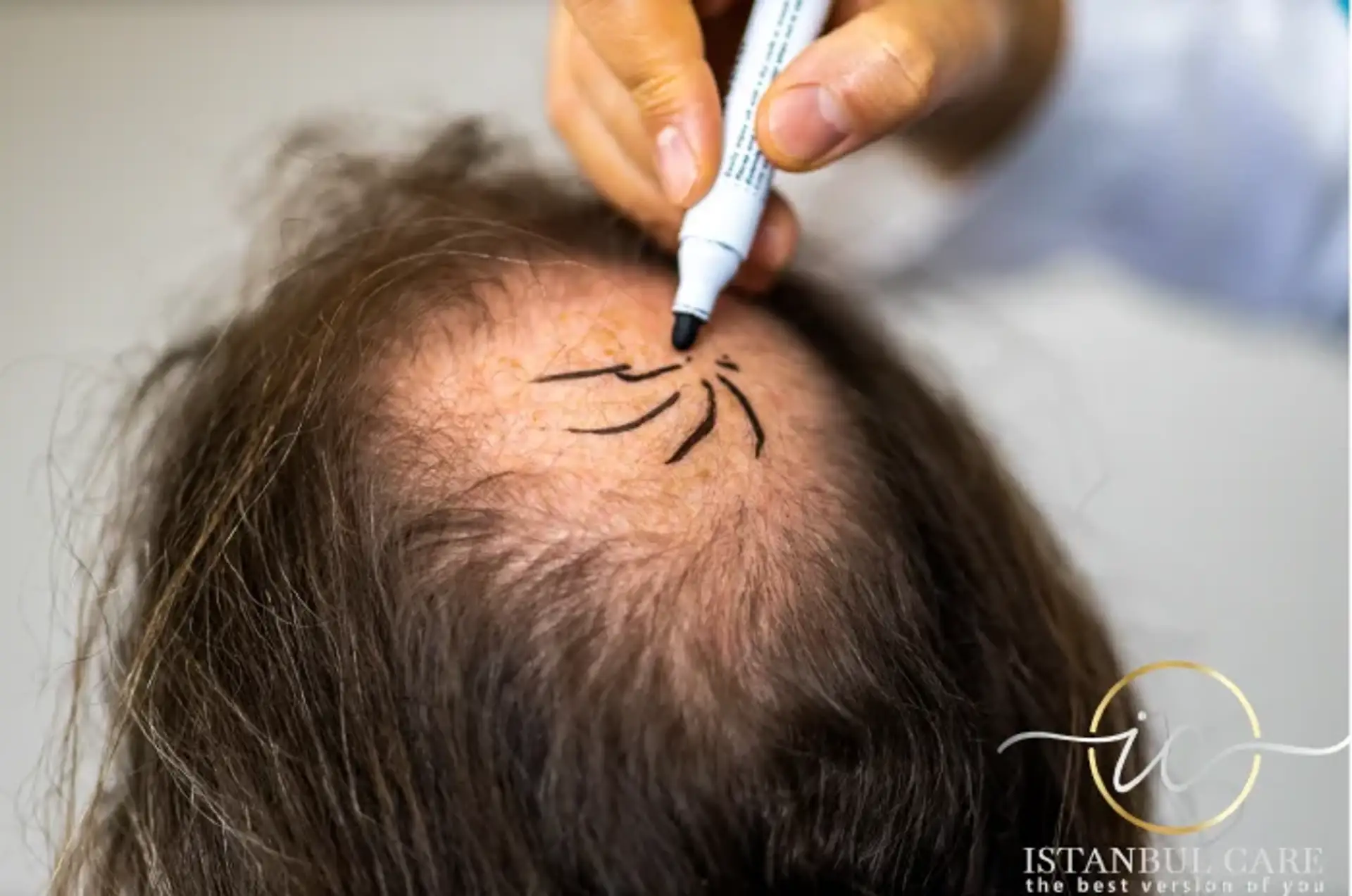 hair transplant consultation in turkey