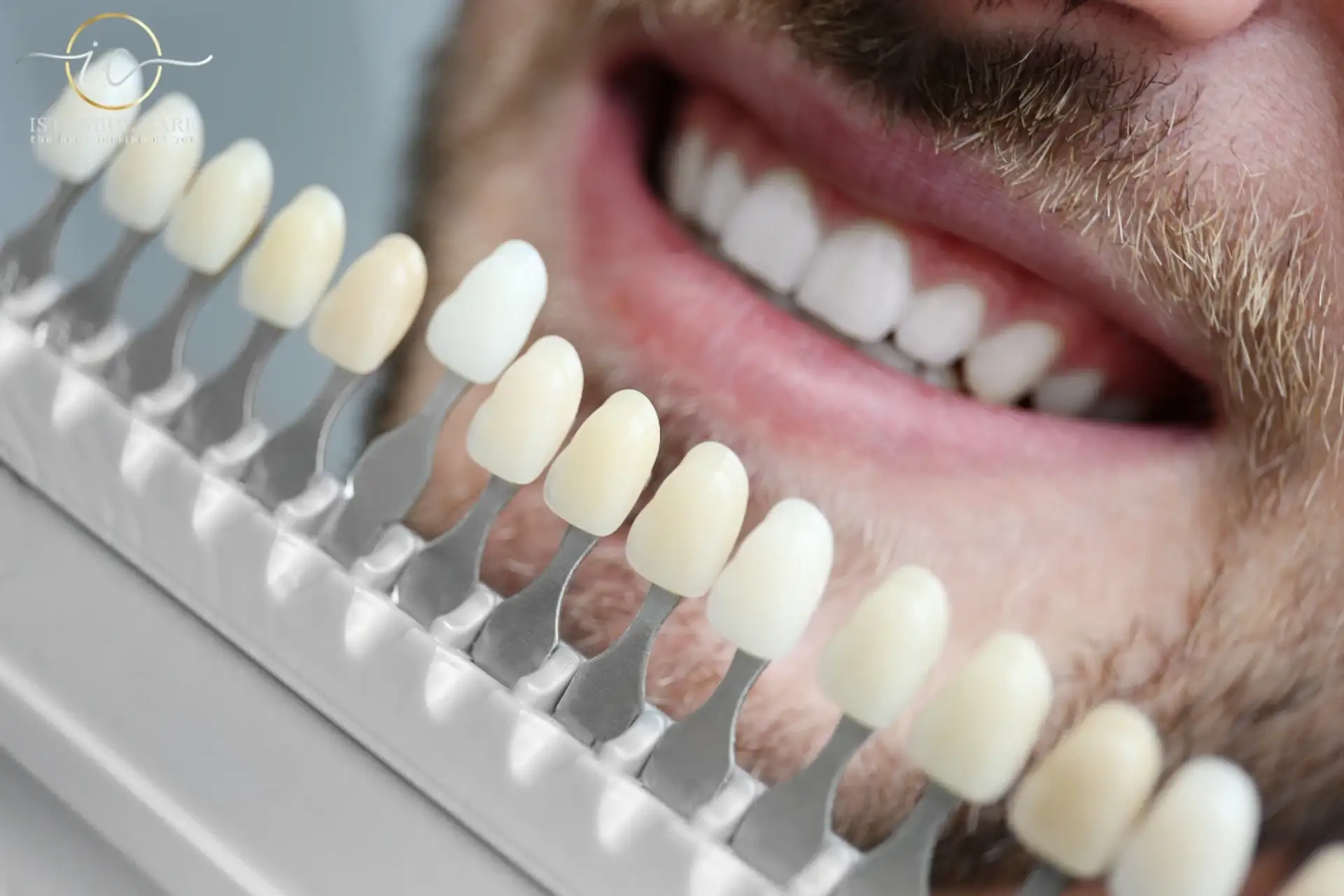 E-max Veneers in Turkey: Affordable Dental Solutions