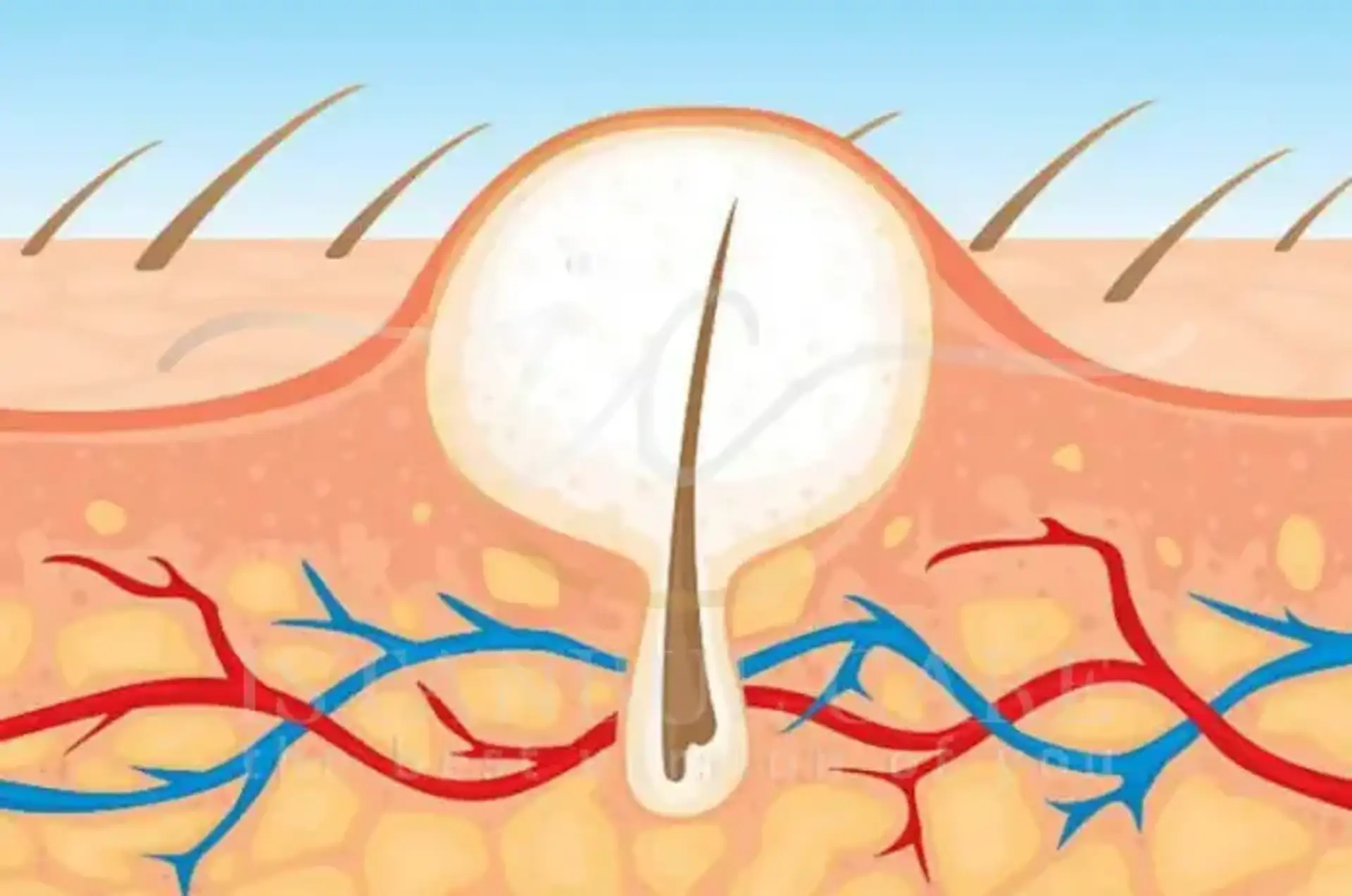 ingrown hair