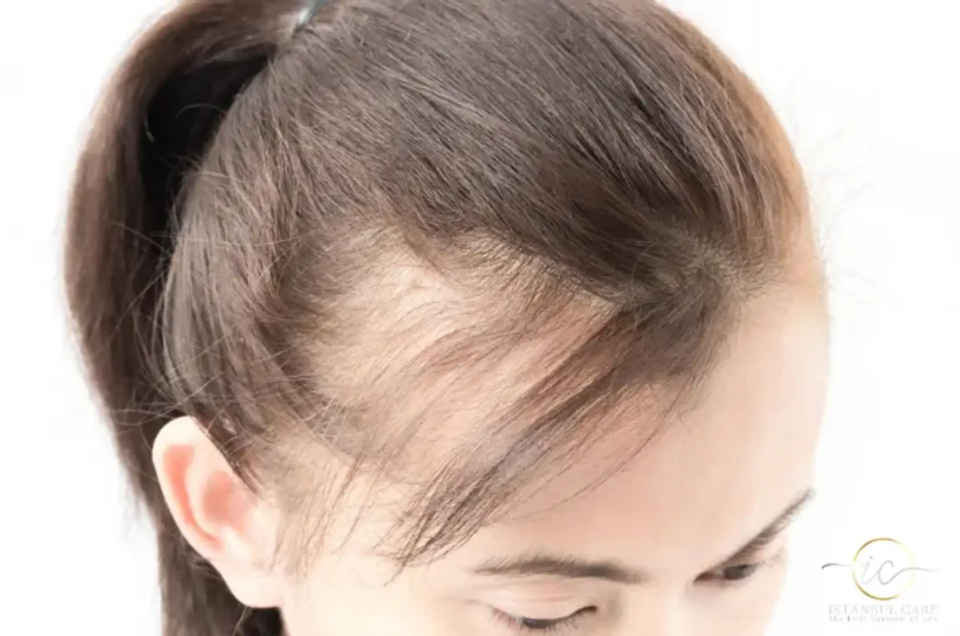 pcos hair loss