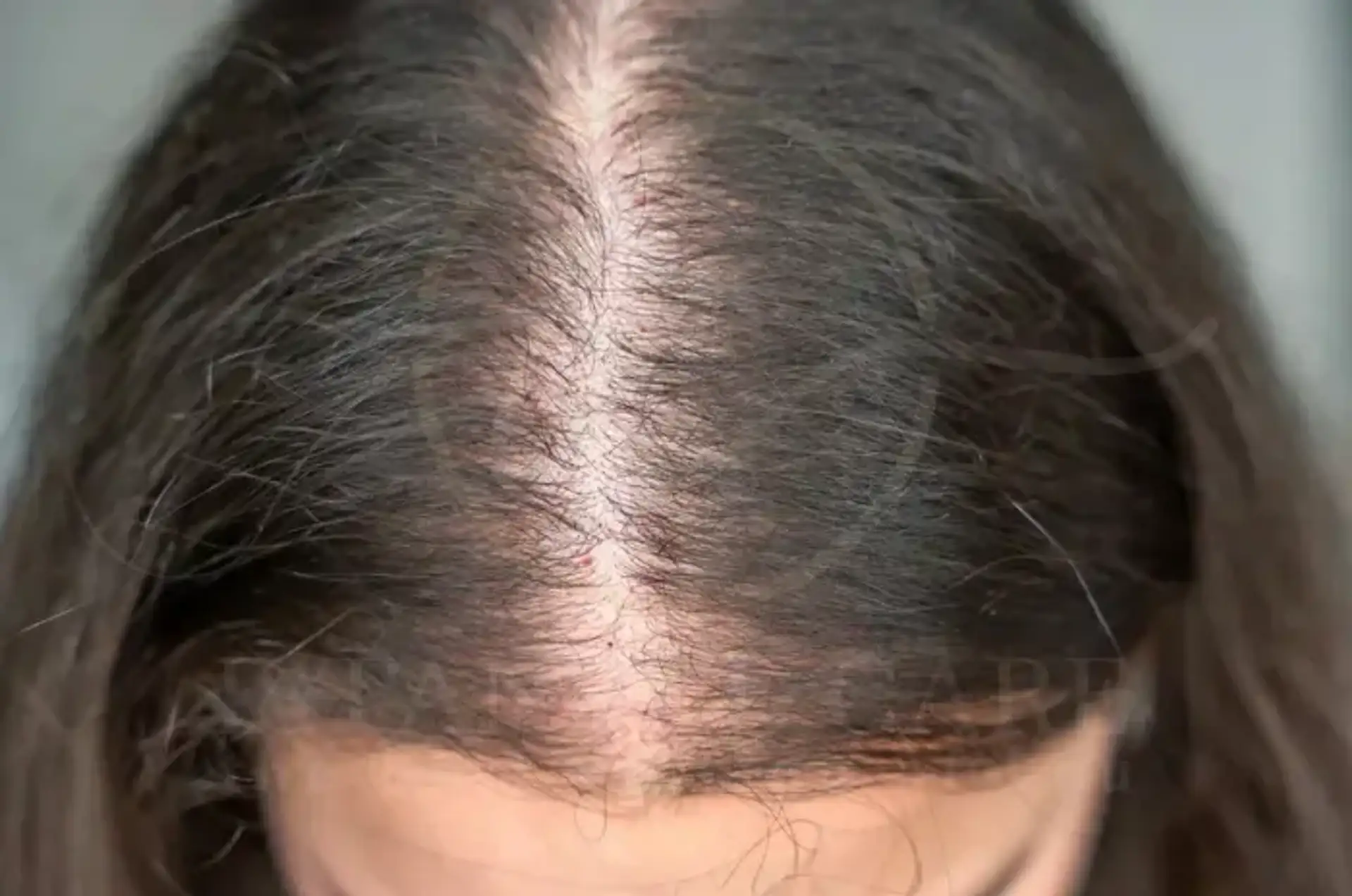 Key Differences Between Traction Alopecia and Pattern Hair Loss (1)