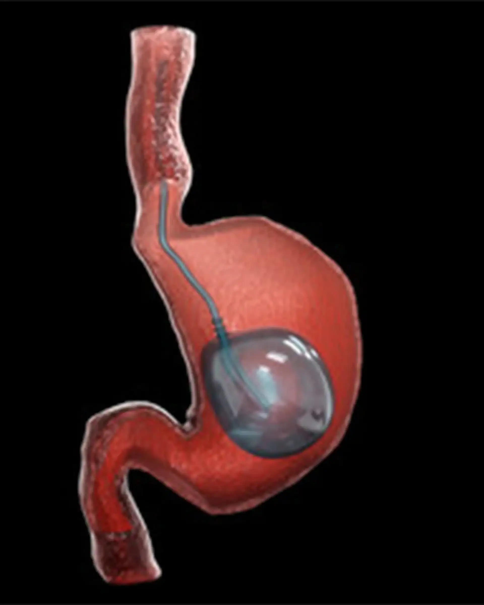 What Is a Gastric Balloon?