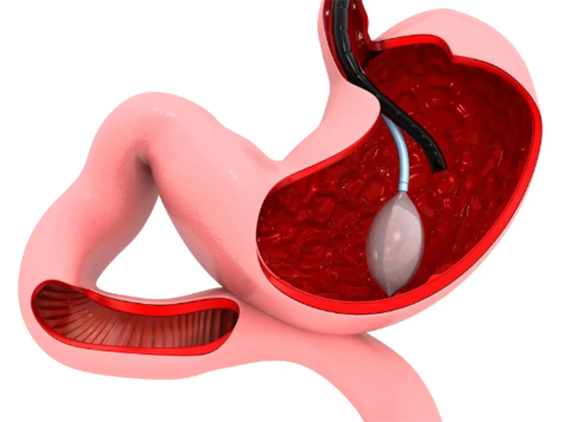 Gastric balloon in Istanbul Care