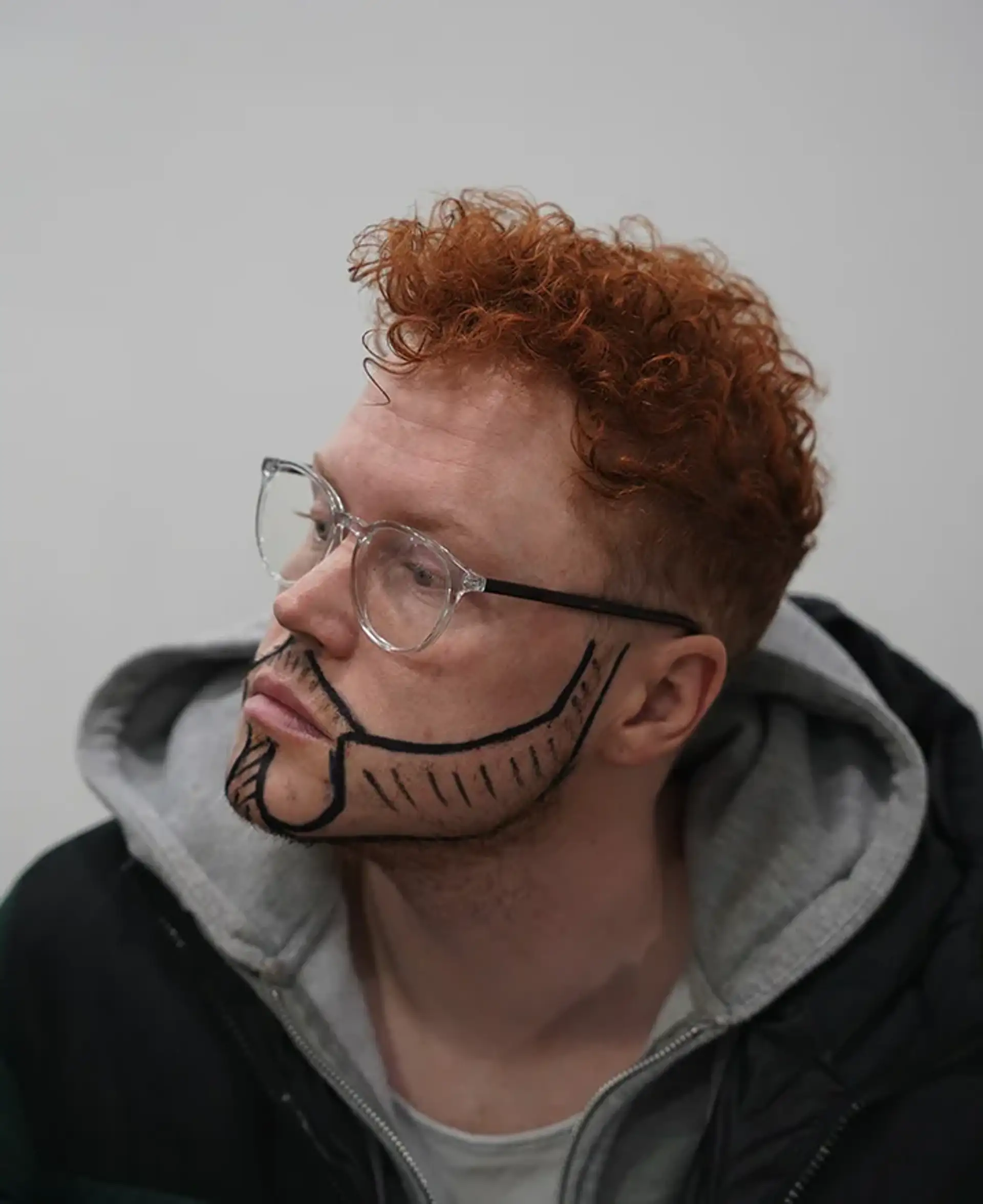 Beard Transplant Procedure Step by Step