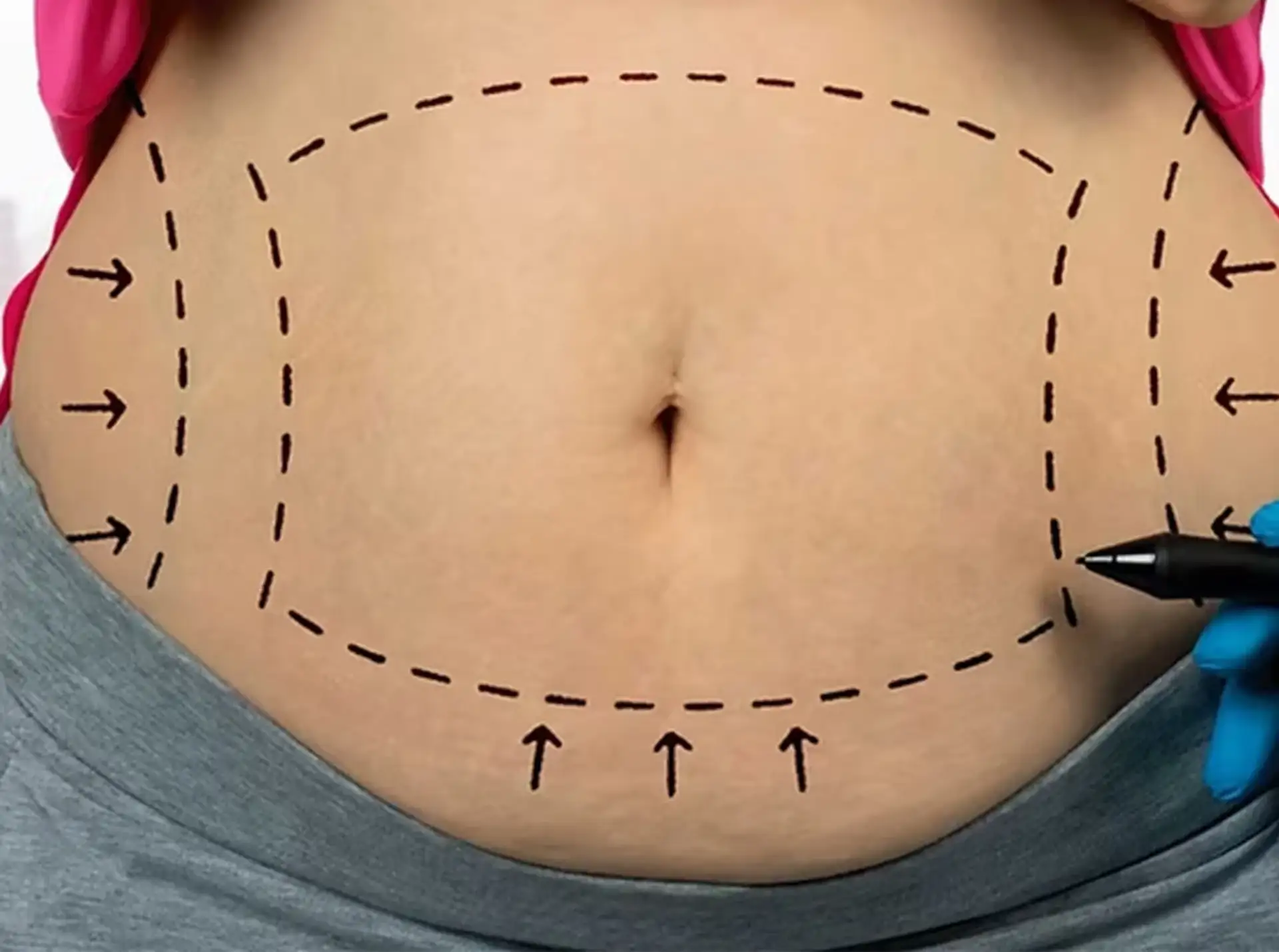 Common Liposuction Treatment Areas