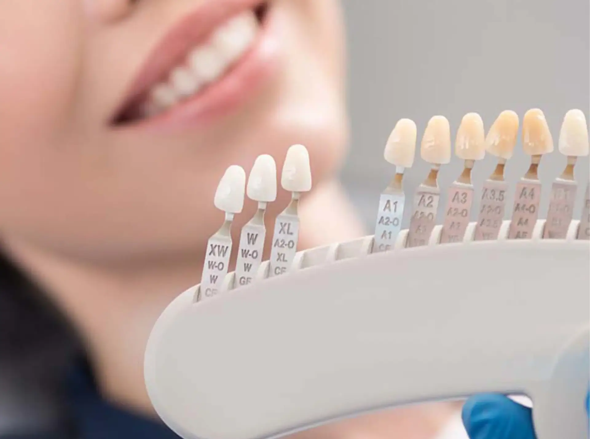 Costo delle faccette E-max in Turchia