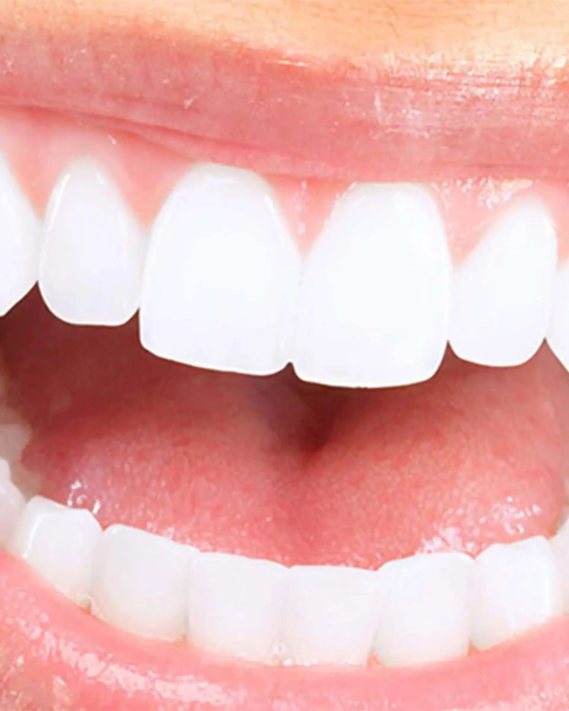 Primo piano di un sorriso luminoso con denti perfettamente bianchi.